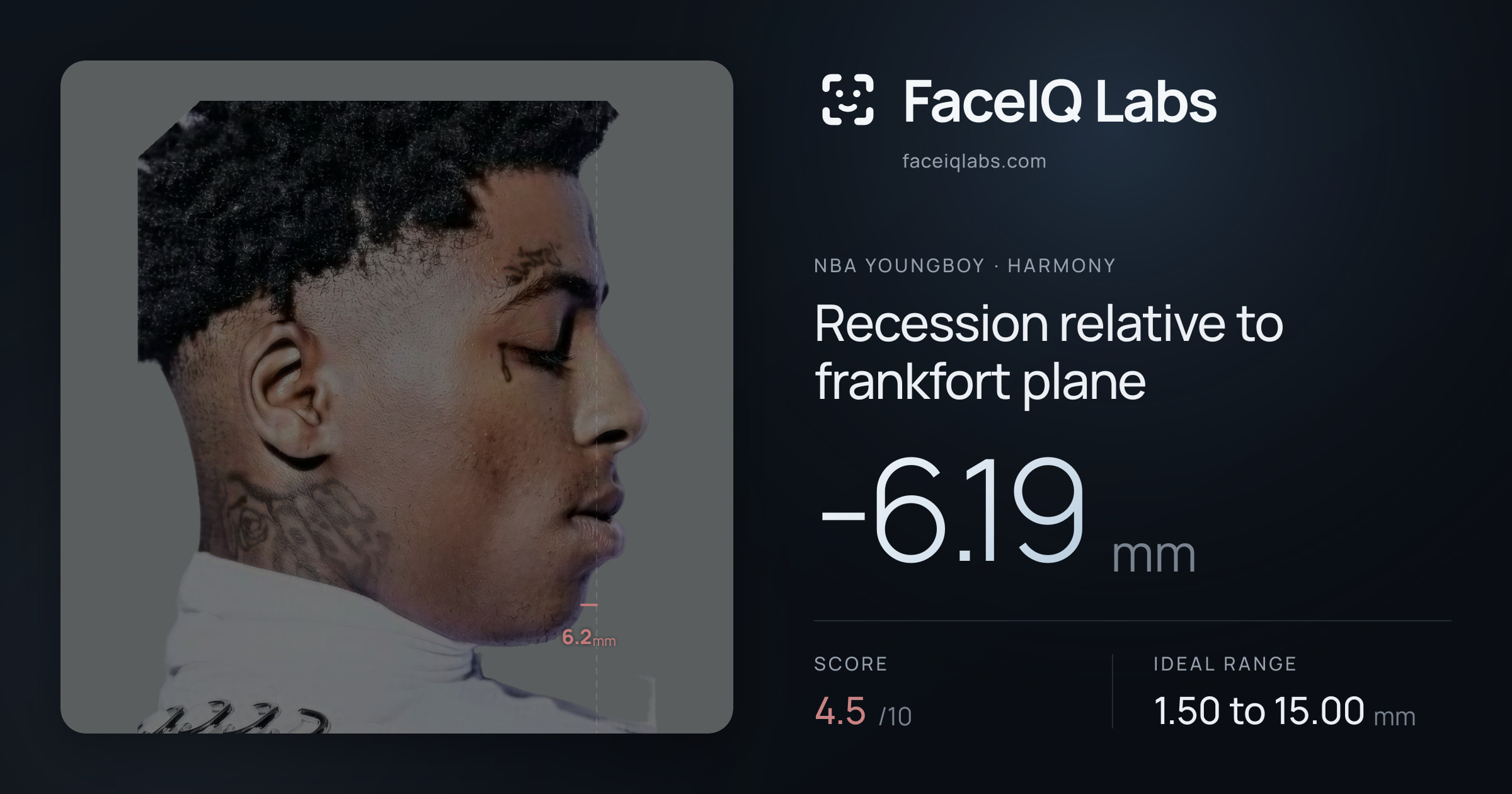 NBA YoungBoy Recession relative to frankfort plane: -6.19mm, drawn on the photo