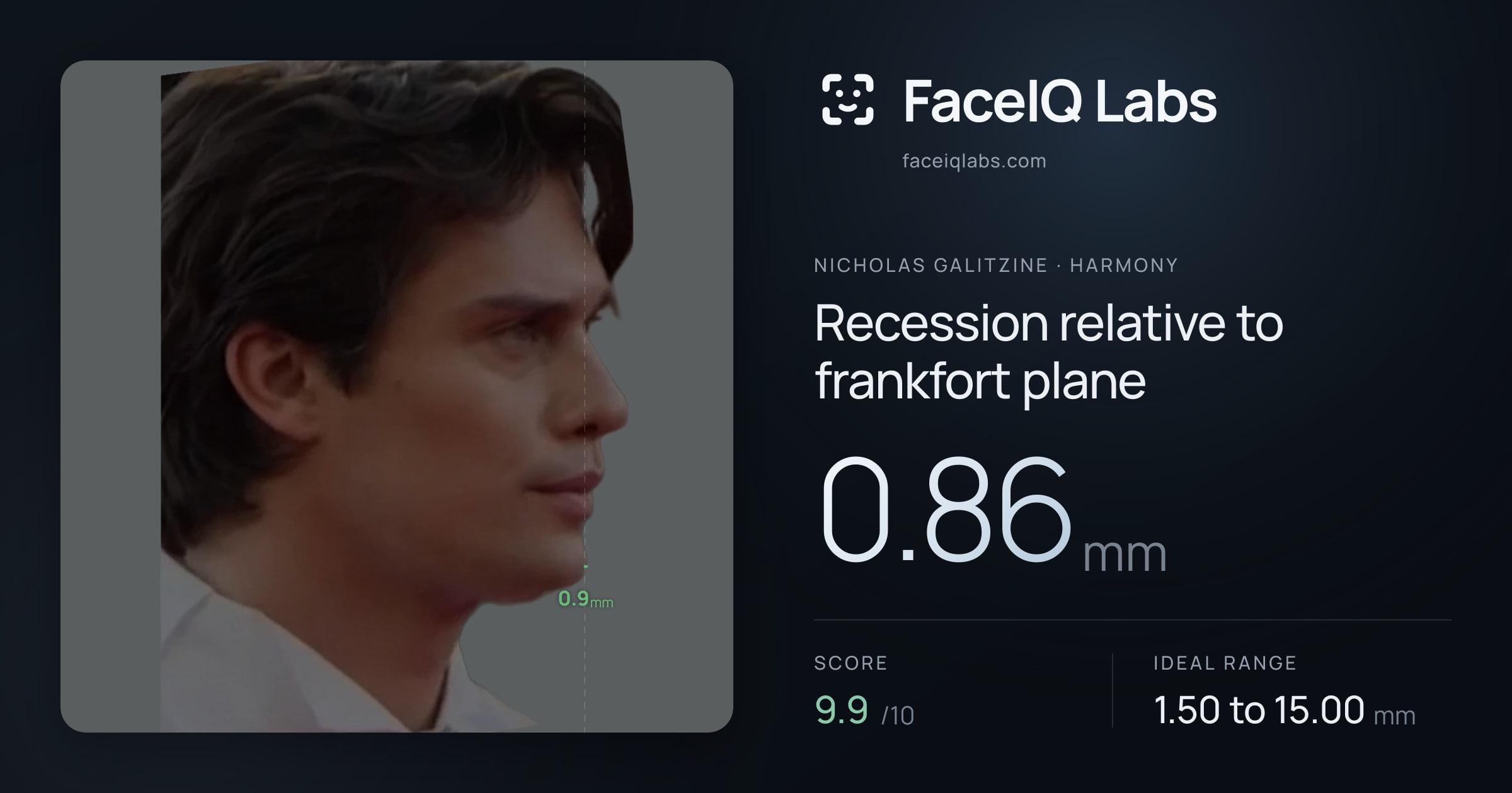 Nicholas Galitzine Recession relative to frankfort plane: 0.86mm, drawn on the photo