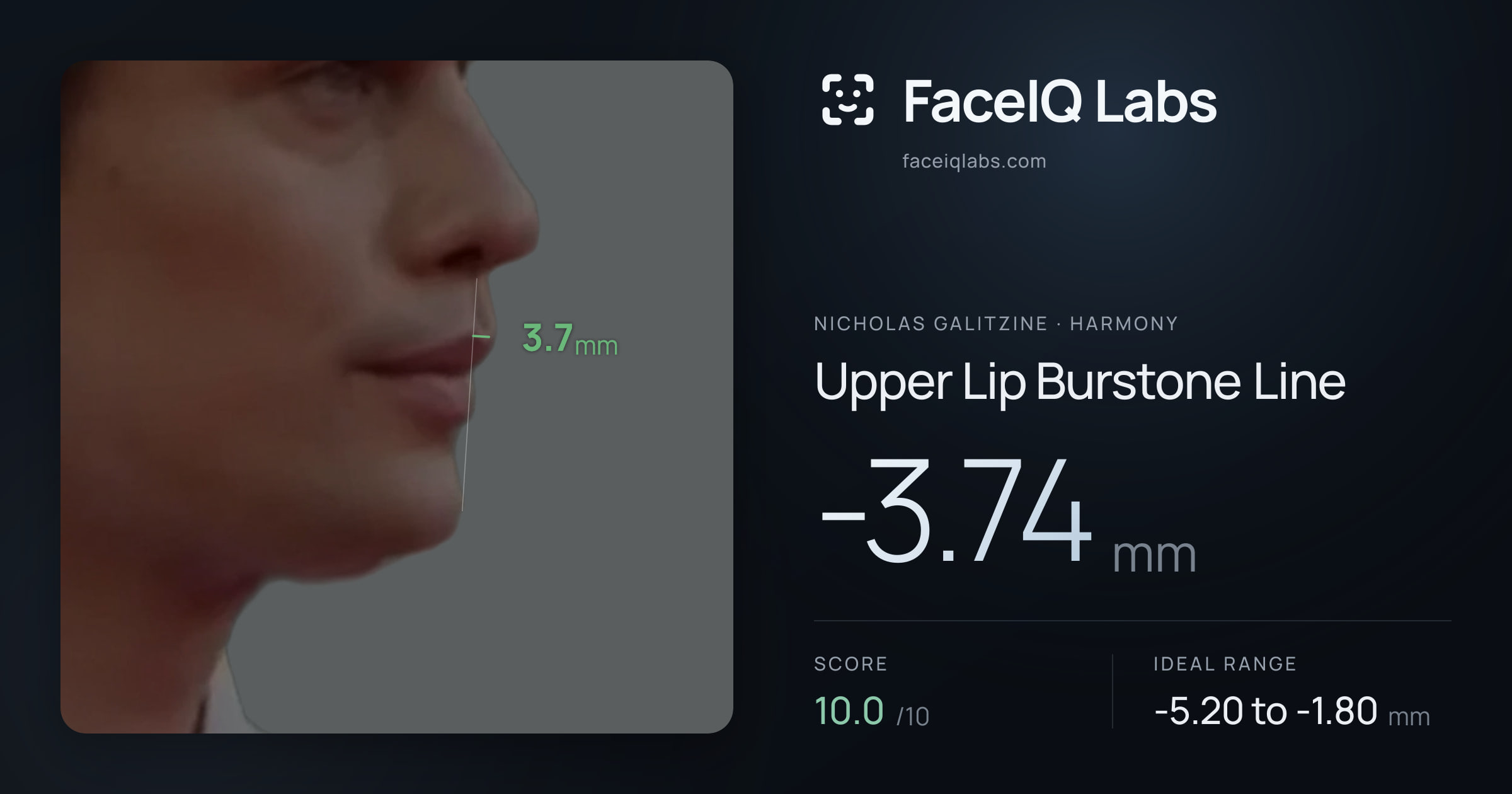 Nicholas Galitzine Upper Lip Burstone Line: -3.74mm, drawn on the photo