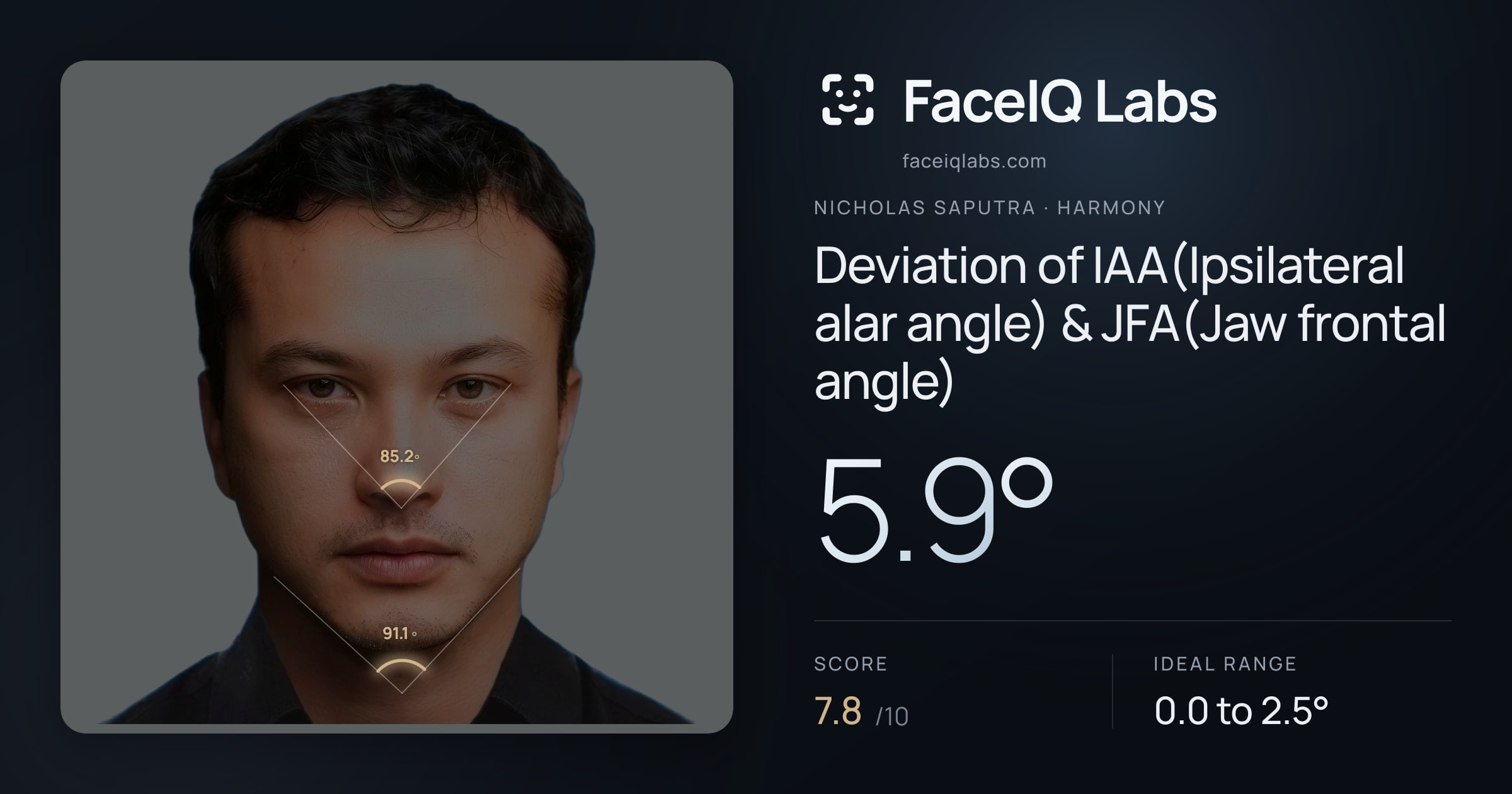 Nicholas Saputra Deviation of IAA(Ipsilateral alar angle) & JFA(Jaw frontal angle): 5.9°, drawn on the photo