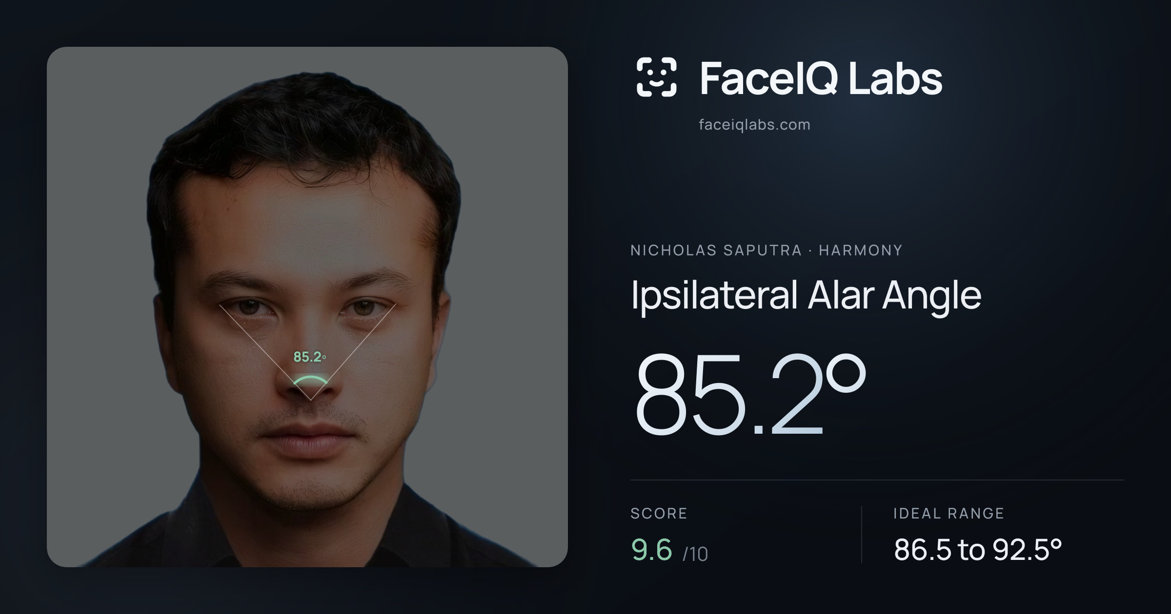 Nicholas Saputra Ipsilateral Alar Angle: 85.2°, drawn on the photo