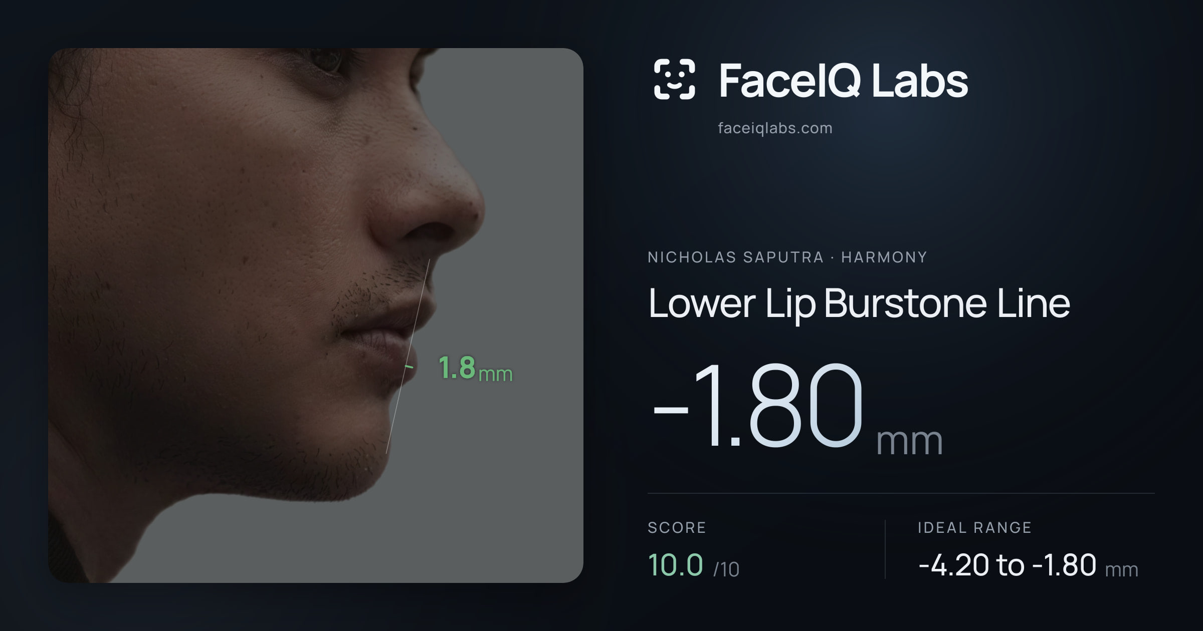 Nicholas Saputra Lower Lip Burstone Line: -1.80mm, drawn on the photo
