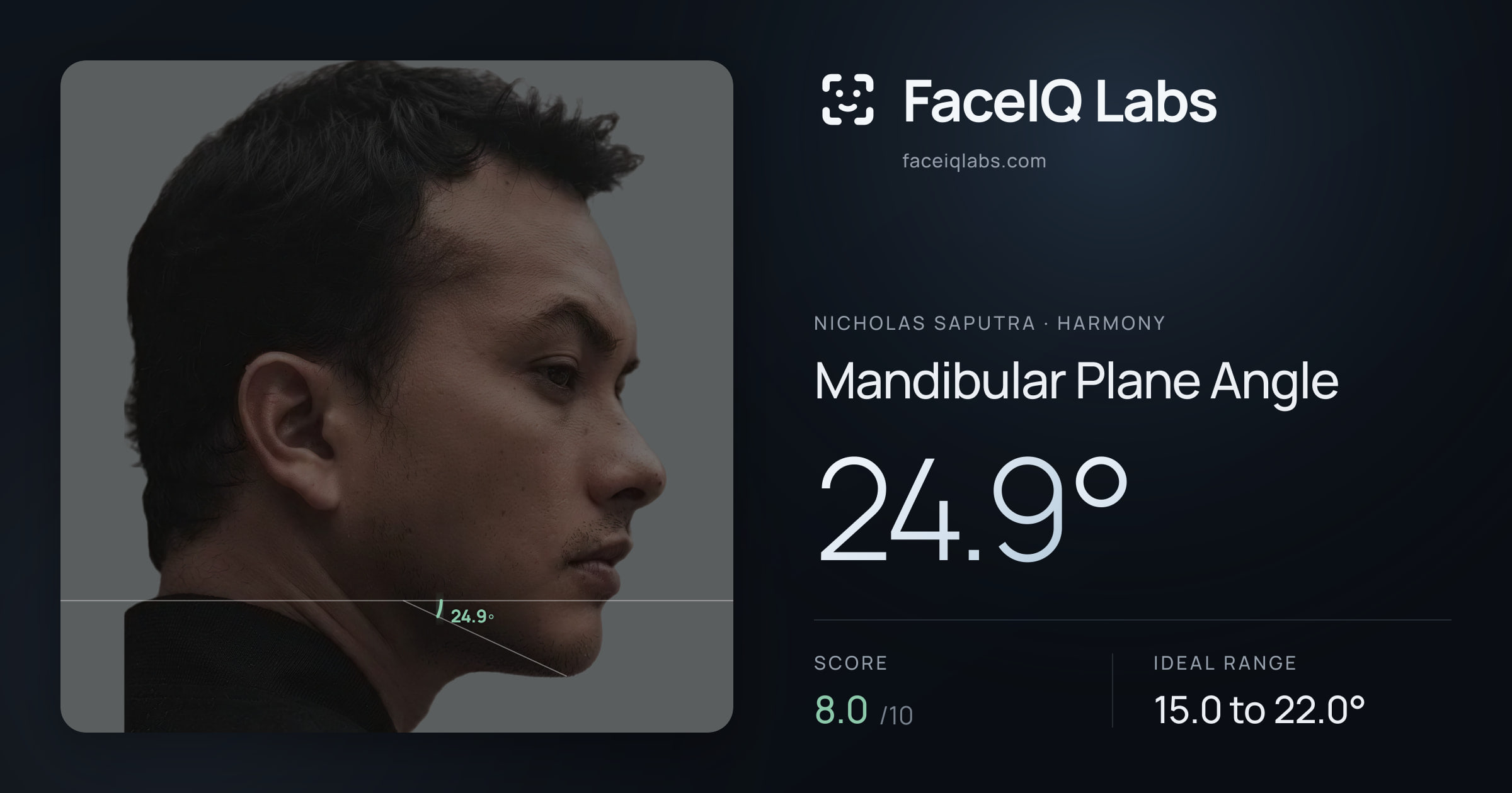 Nicholas Saputra Mandibular Plane Angle: 24.9°, drawn on the photo