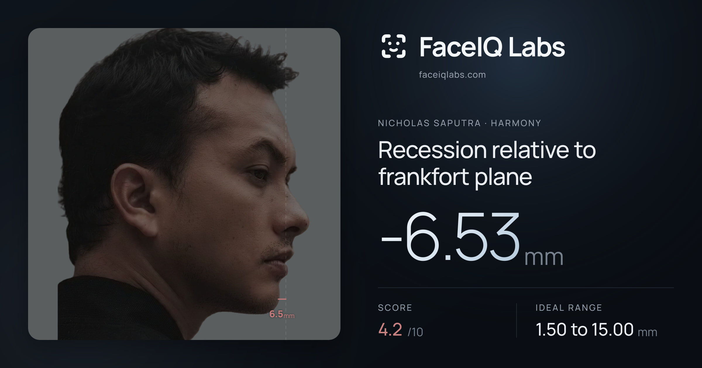 Nicholas Saputra Recession relative to frankfort plane: -6.53mm, drawn on the photo
