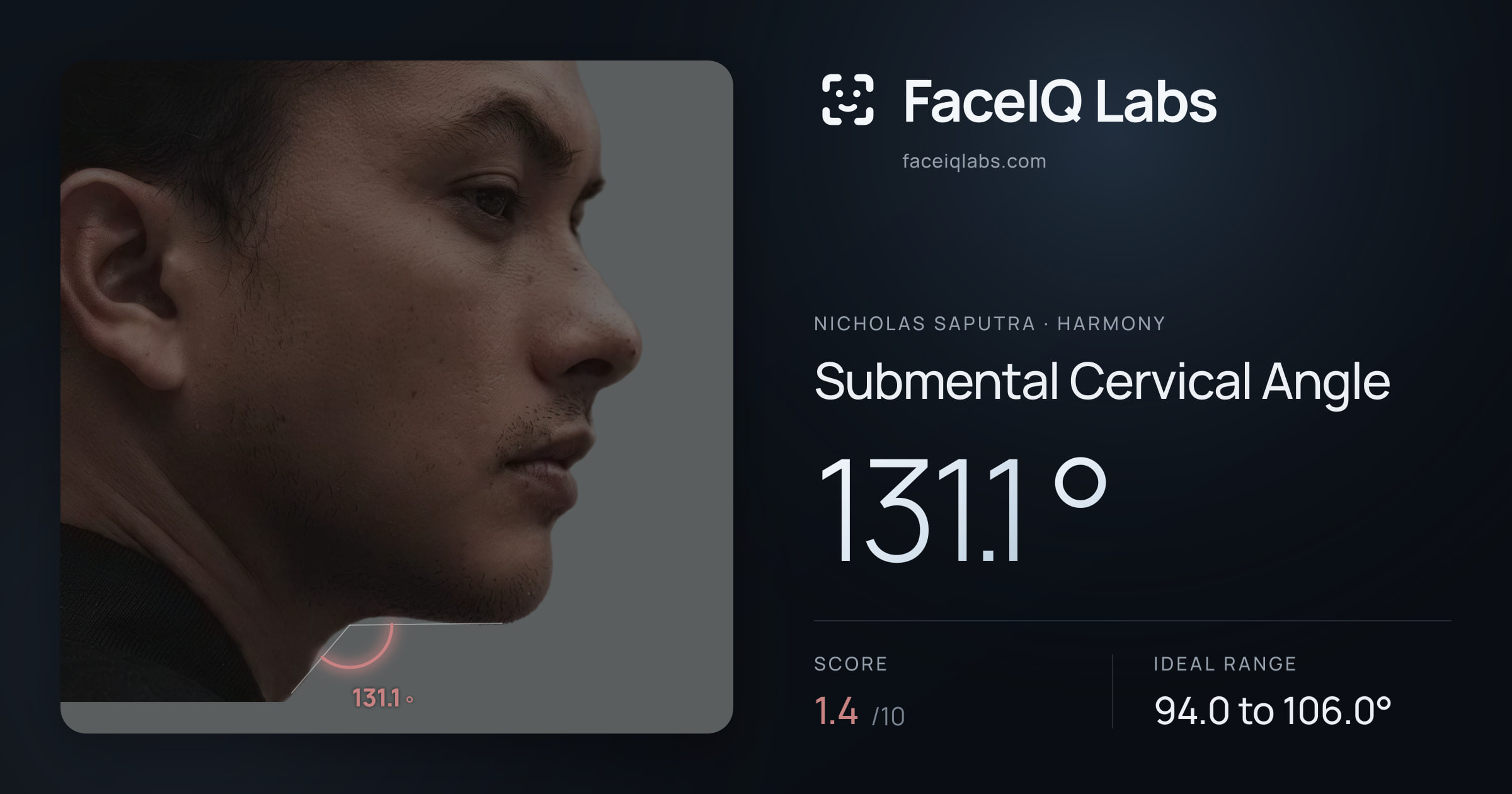 Nicholas Saputra Submental Cervical Angle: 131.1°, drawn on the photo