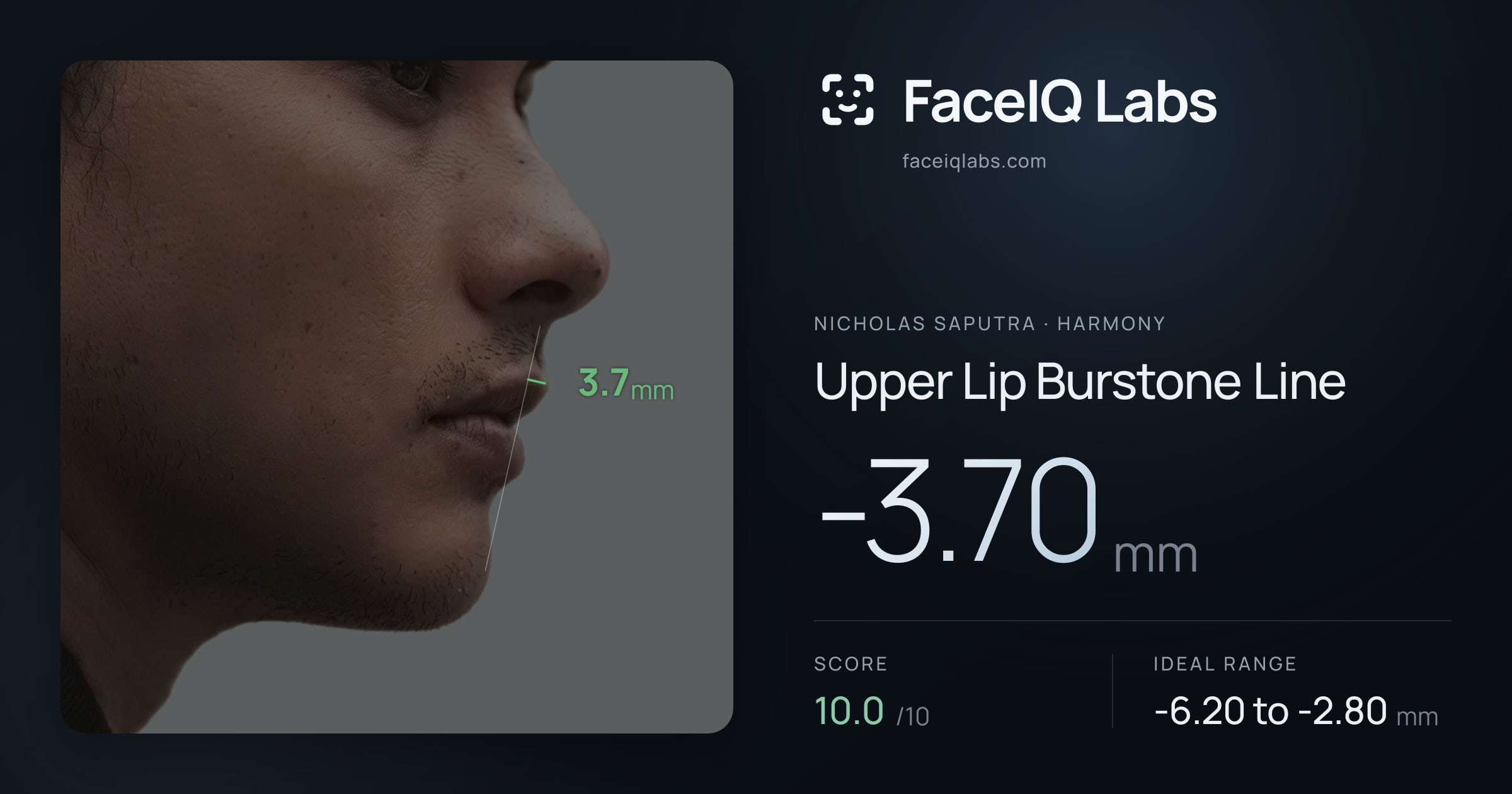 Nicholas Saputra Upper Lip Burstone Line: -3.70mm, drawn on the photo