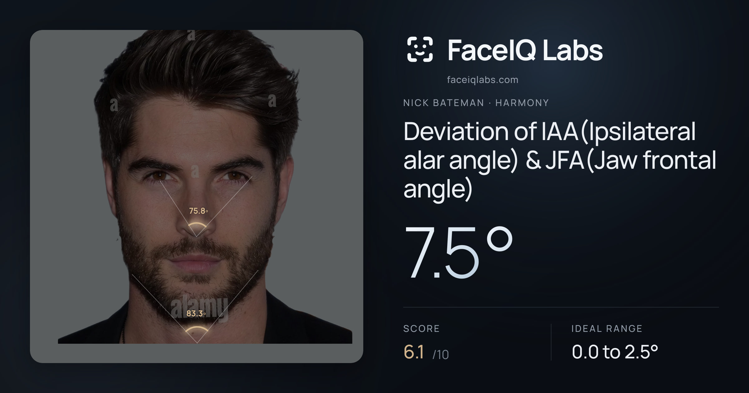 Nick Bateman Deviation of IAA(Ipsilateral alar angle) & JFA(Jaw frontal angle): 7.5°, drawn on the photo
