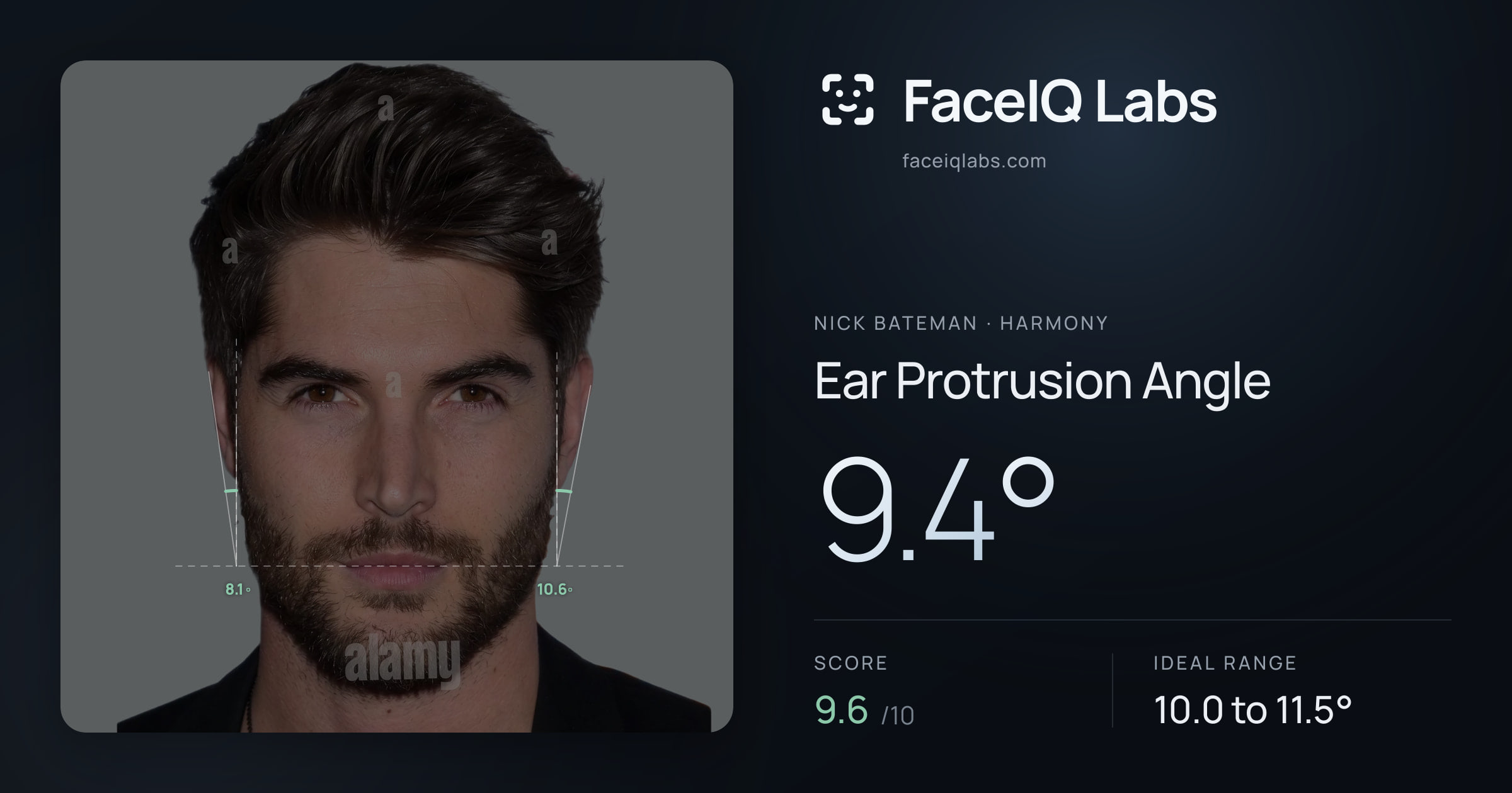 Nick Bateman Ear Protrusion Angle: 67.7°, drawn on the photo