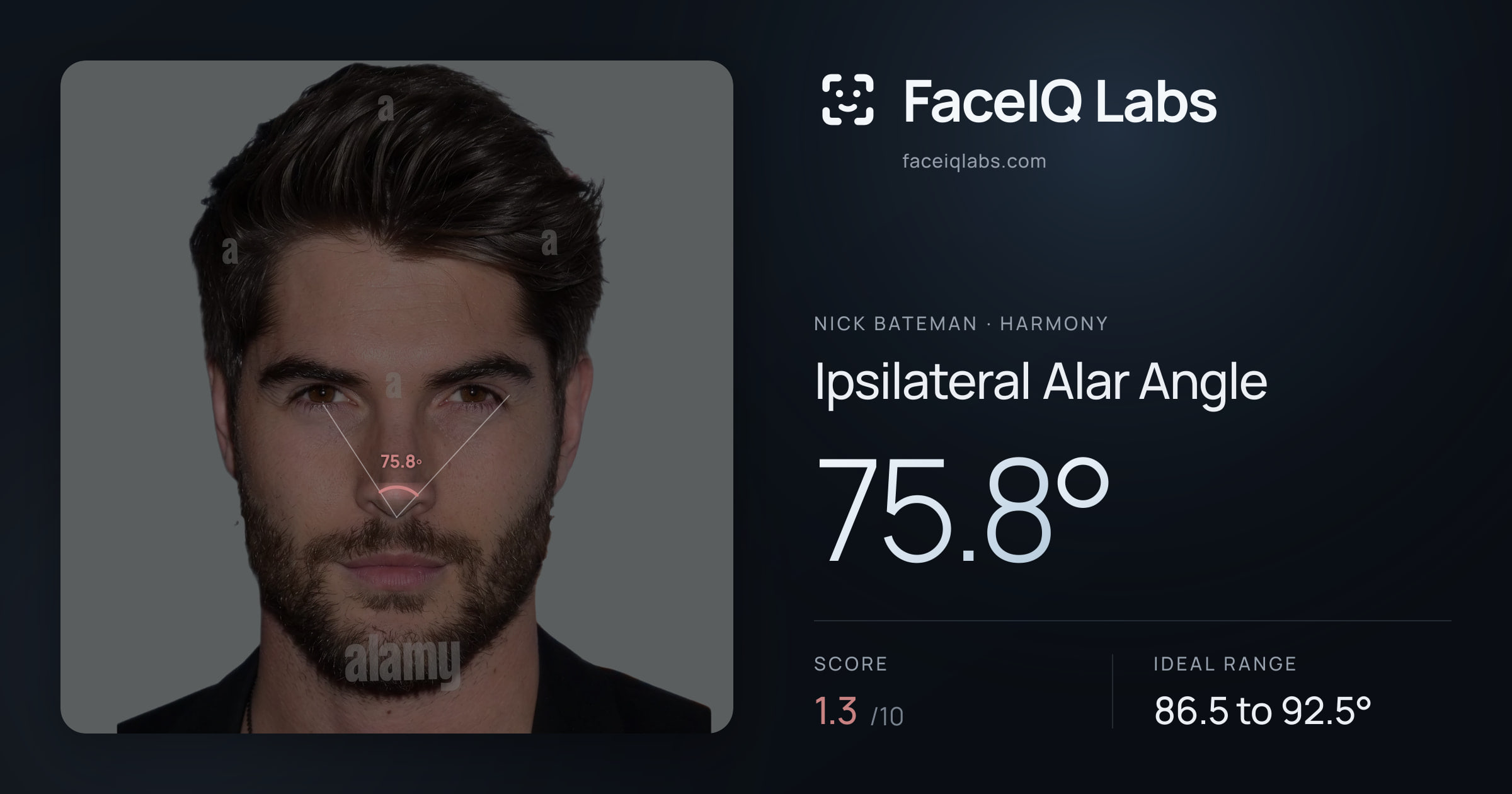 Nick Bateman Ipsilateral Alar Angle: 75.8°, drawn on the photo