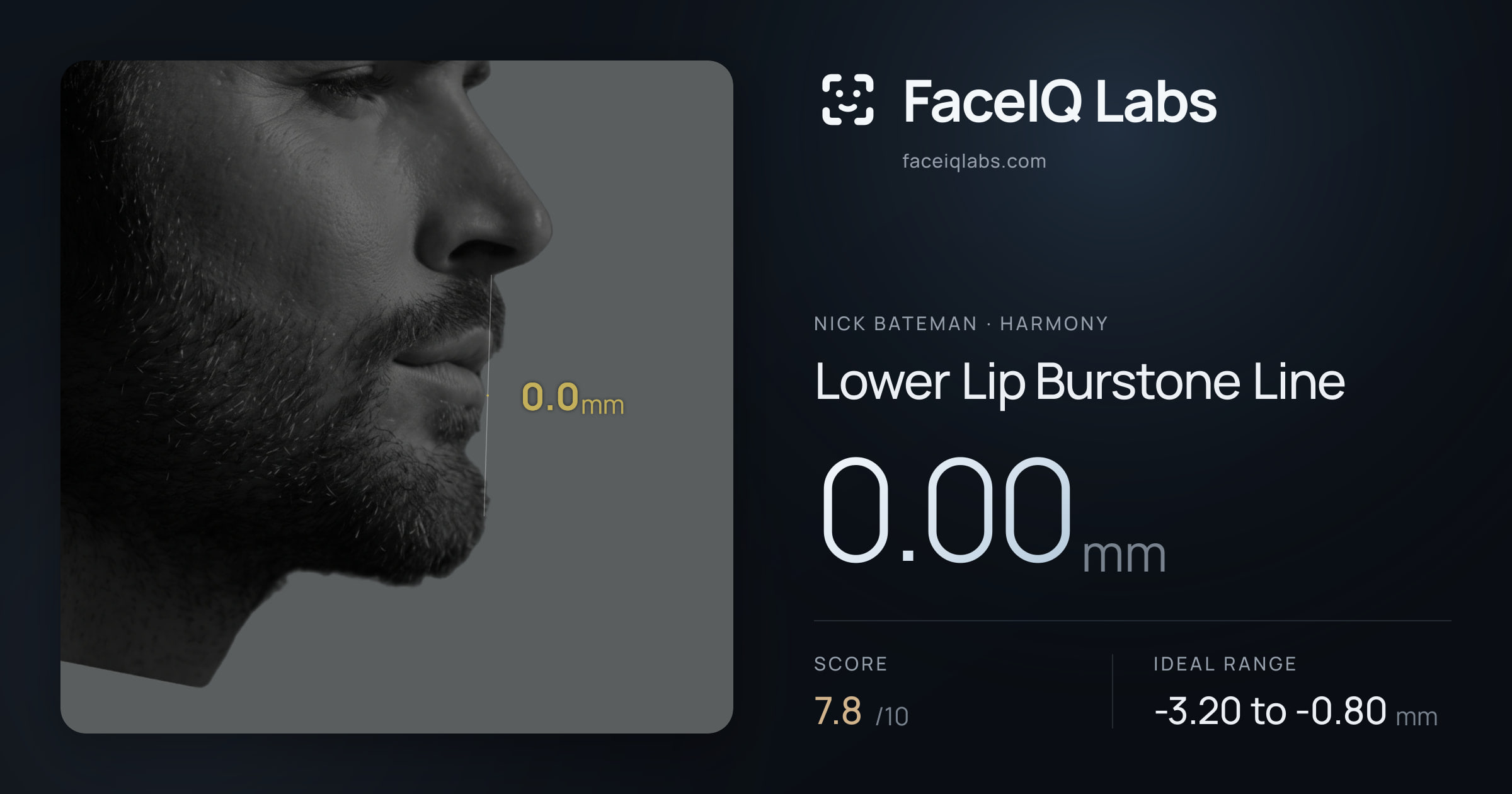 Nick Bateman Lower Lip Burstone Line: 0.00mm, drawn on the photo