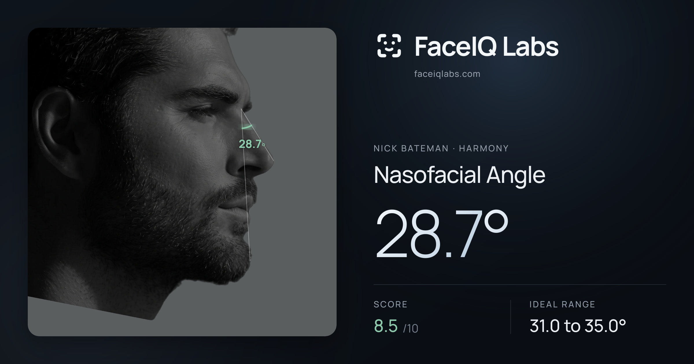 Nick Bateman Nasofacial Angle: 28.7°, drawn on the photo