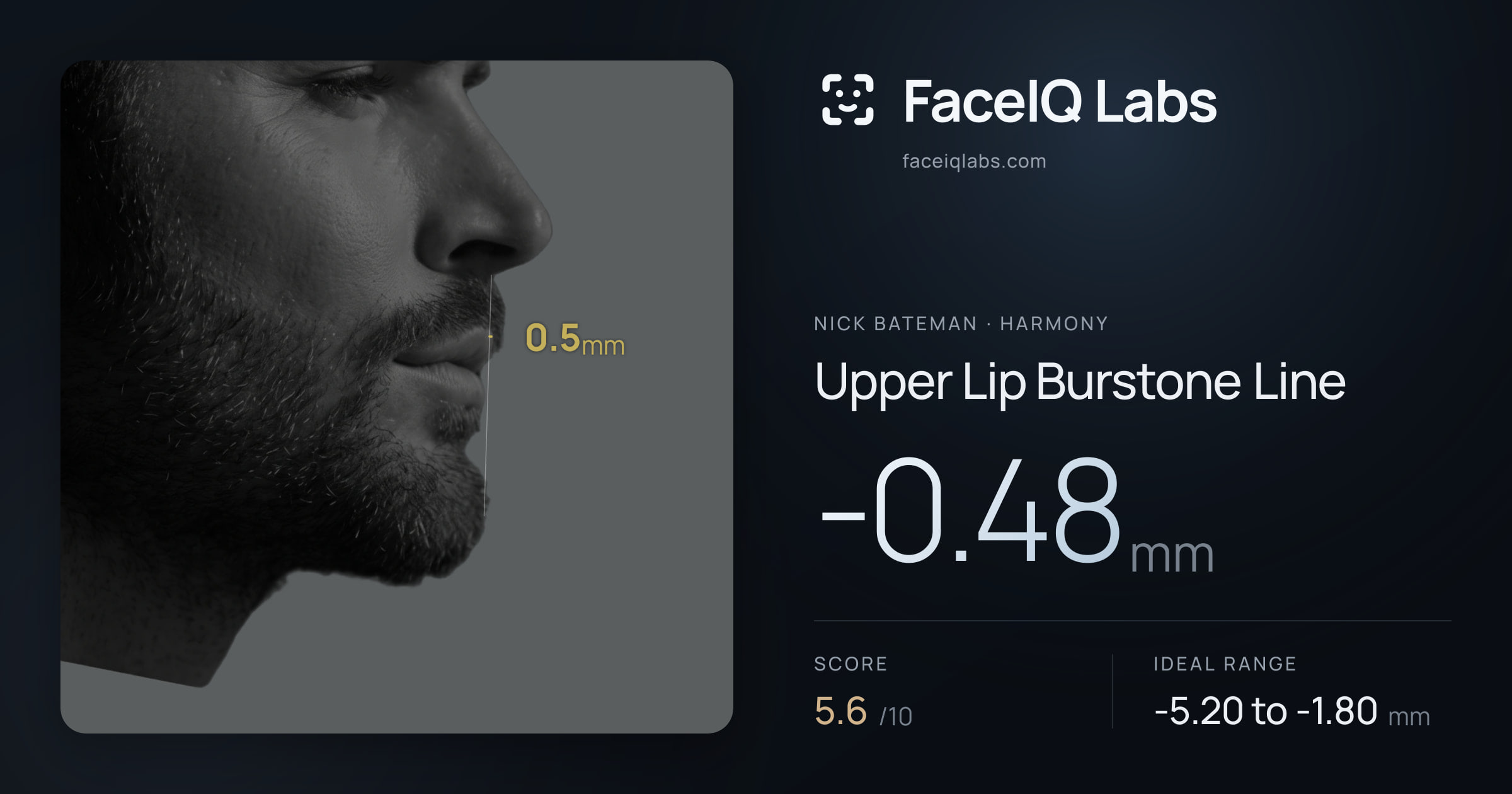 Nick Bateman Upper Lip Burstone Line: -0.48mm, drawn on the photo
