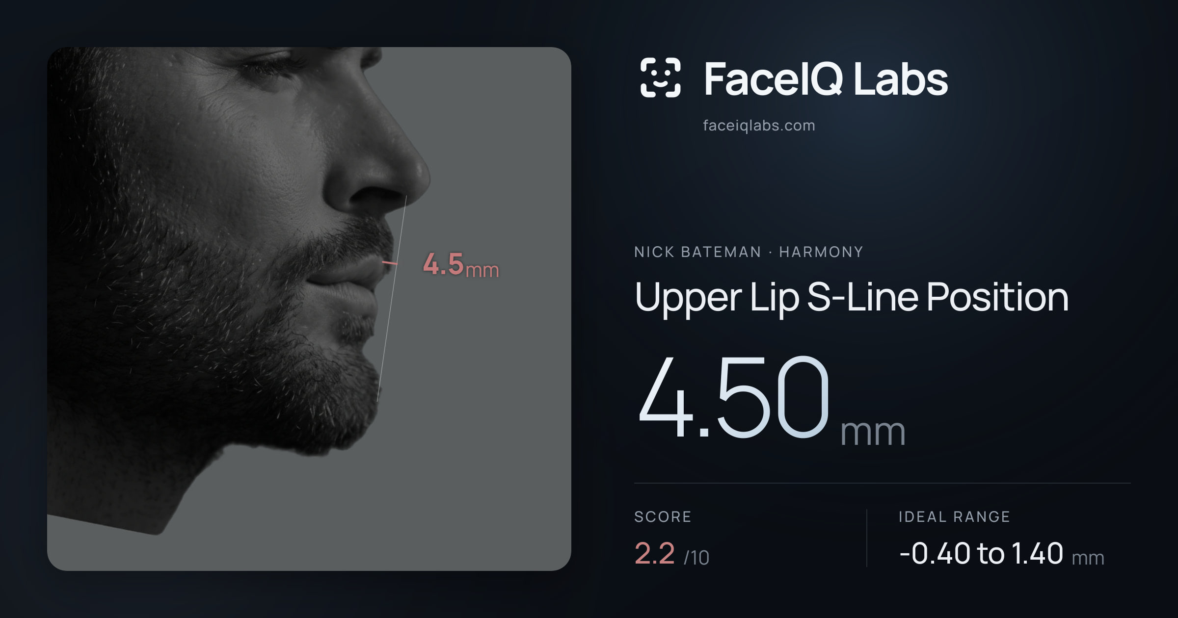 Nick Bateman Upper Lip S-Line Position: 4.50mm, drawn on the photo