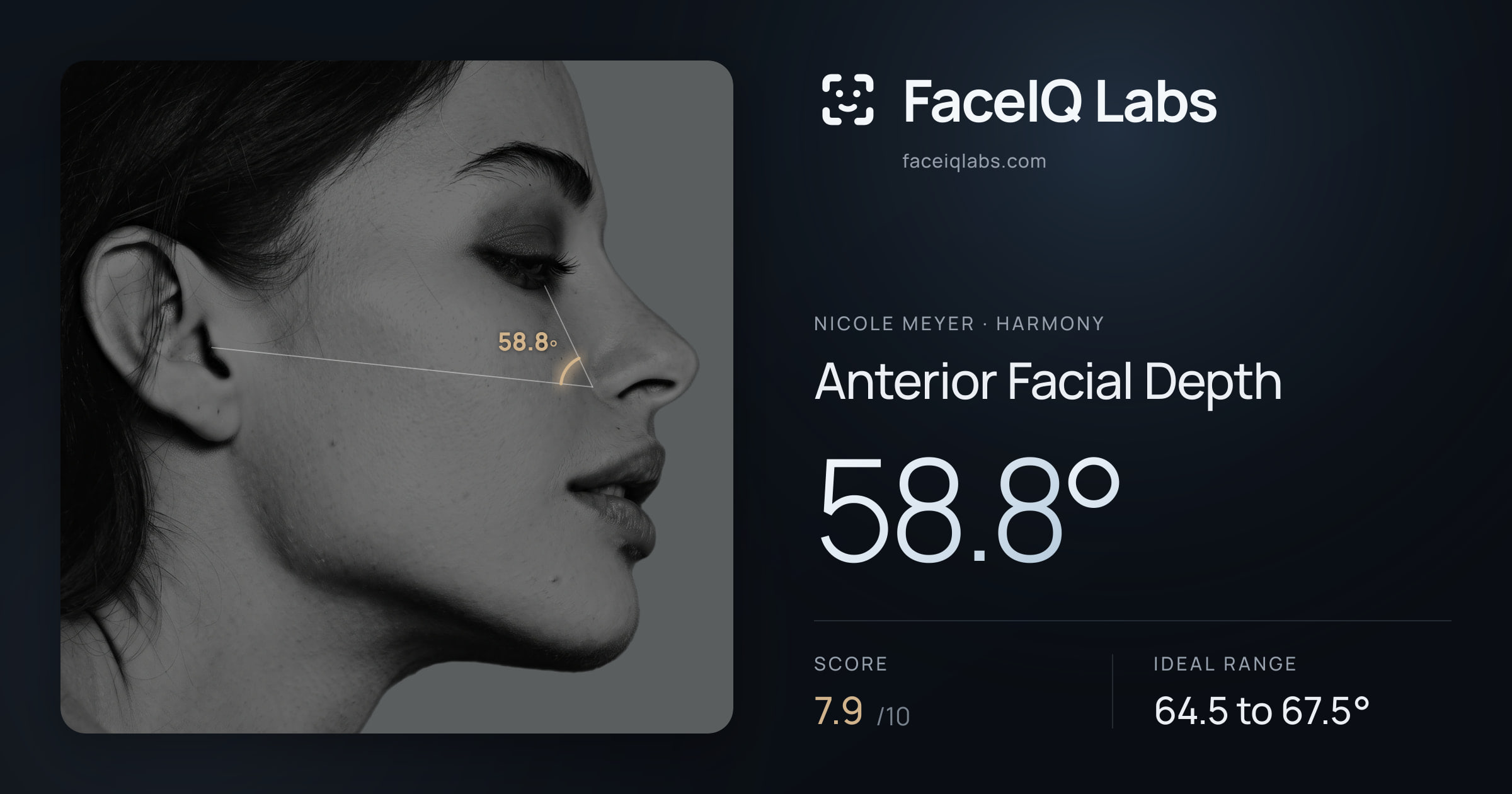 Nicole Meyer Anterior Facial Depth: 58.8°, drawn on the photo