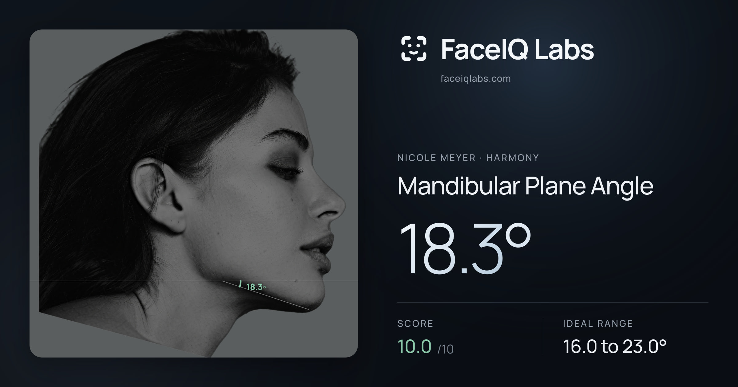 Nicole Meyer Mandibular Plane Angle: 18.3°, drawn on the photo