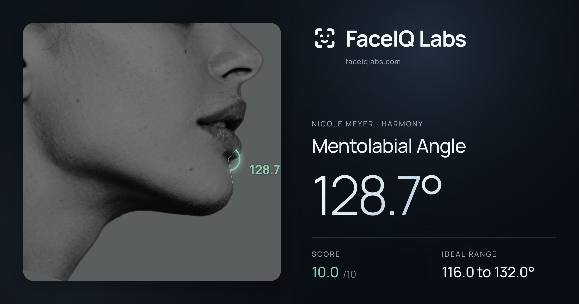 Nicole Meyer Mentolabial Angle: 128.7°, drawn on the photo
