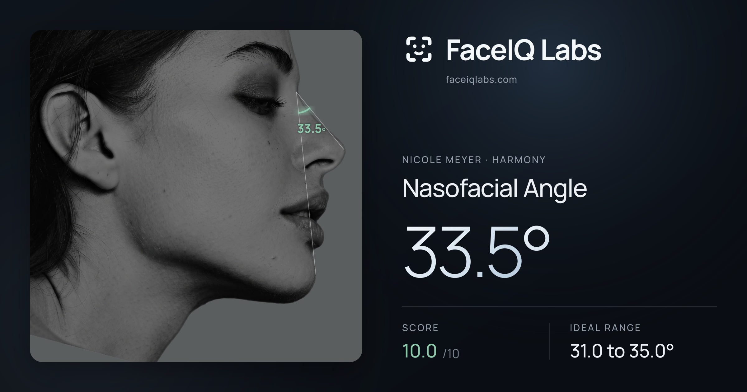 Nicole Meyer Nasofacial Angle: 33.5°, drawn on the photo