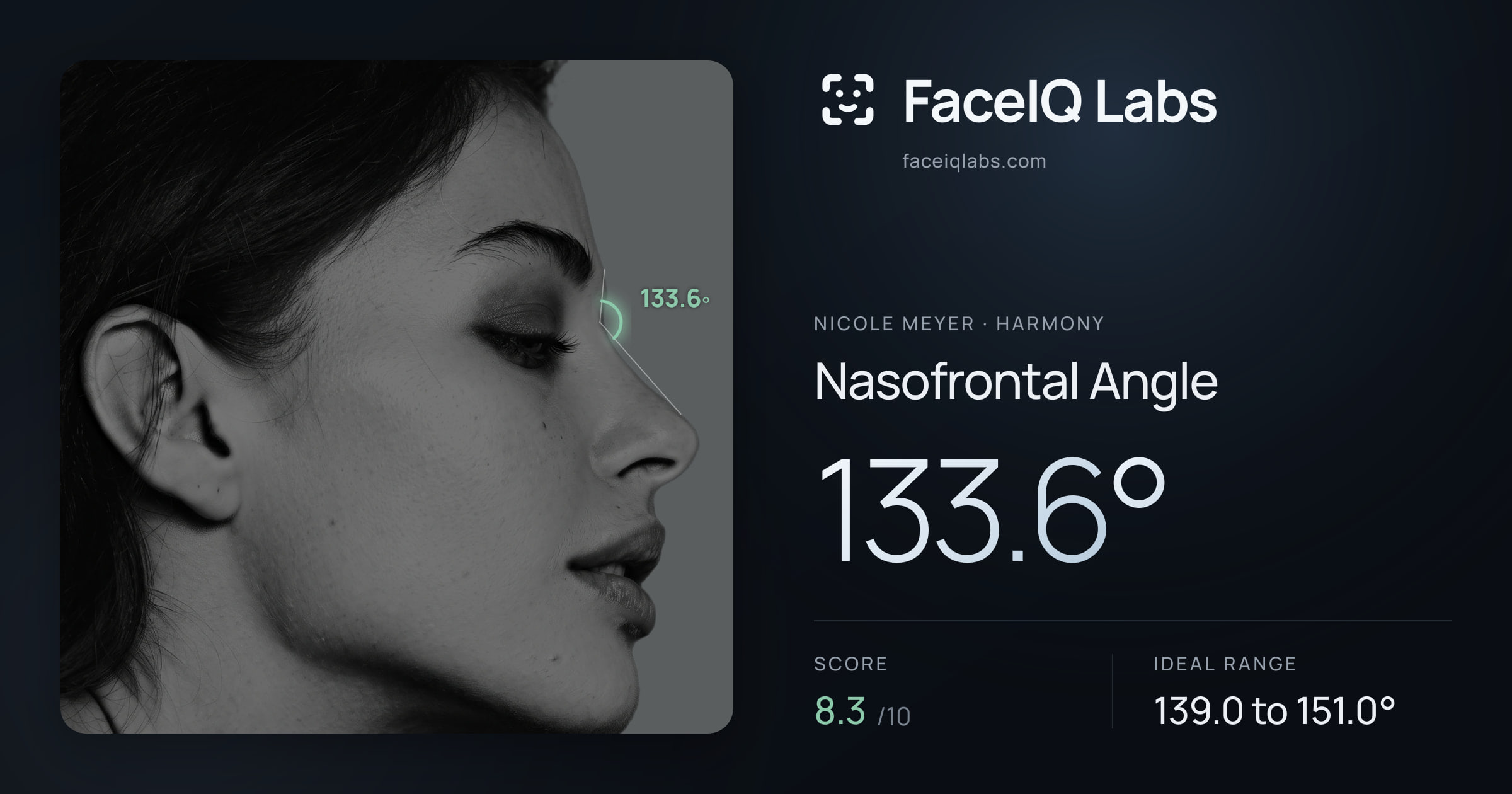 Nicole Meyer Nasofrontal Angle: 133.6°, drawn on the photo