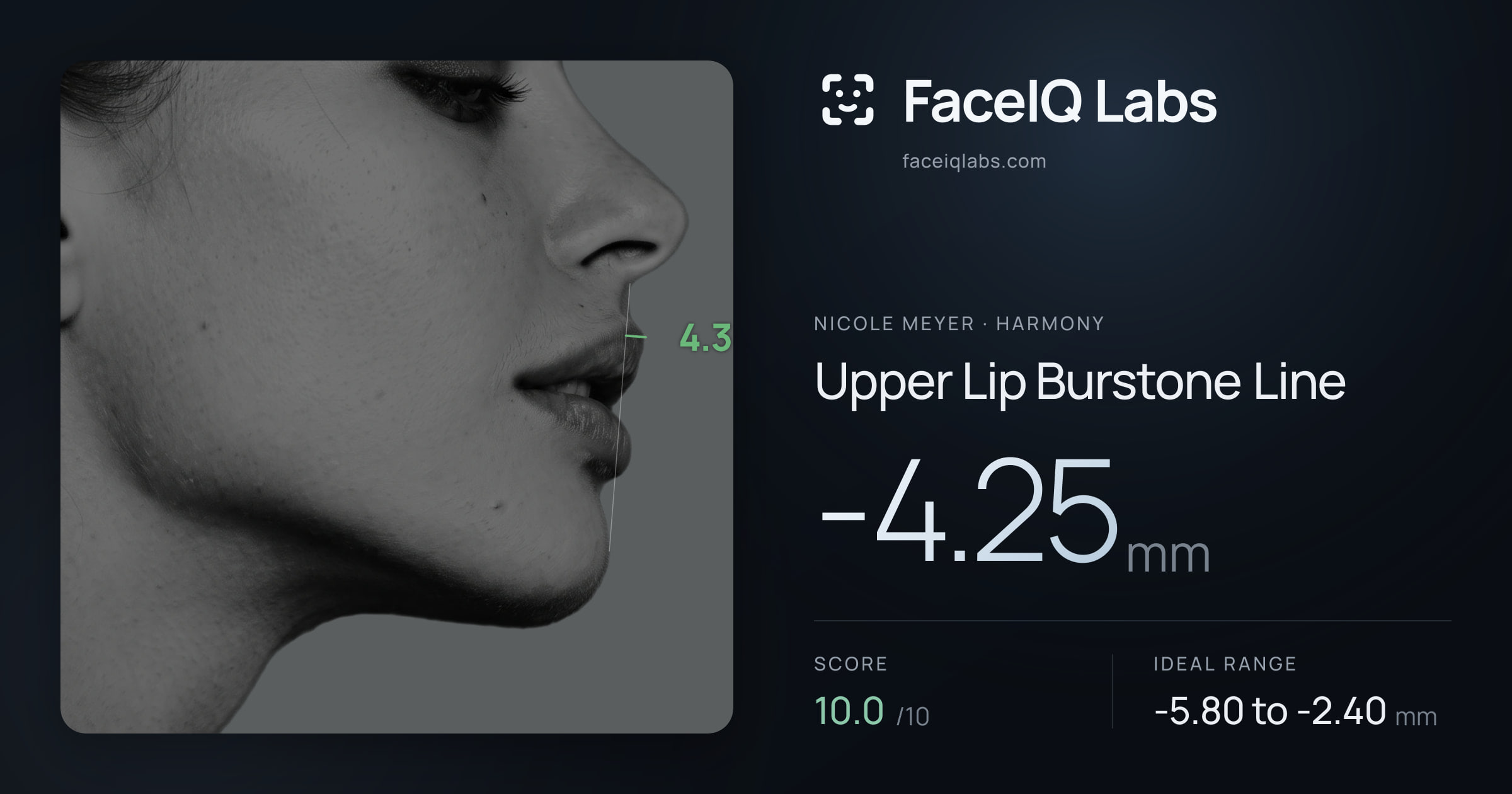 Nicole Meyer Upper Lip Burstone Line: -4.25mm, drawn on the photo