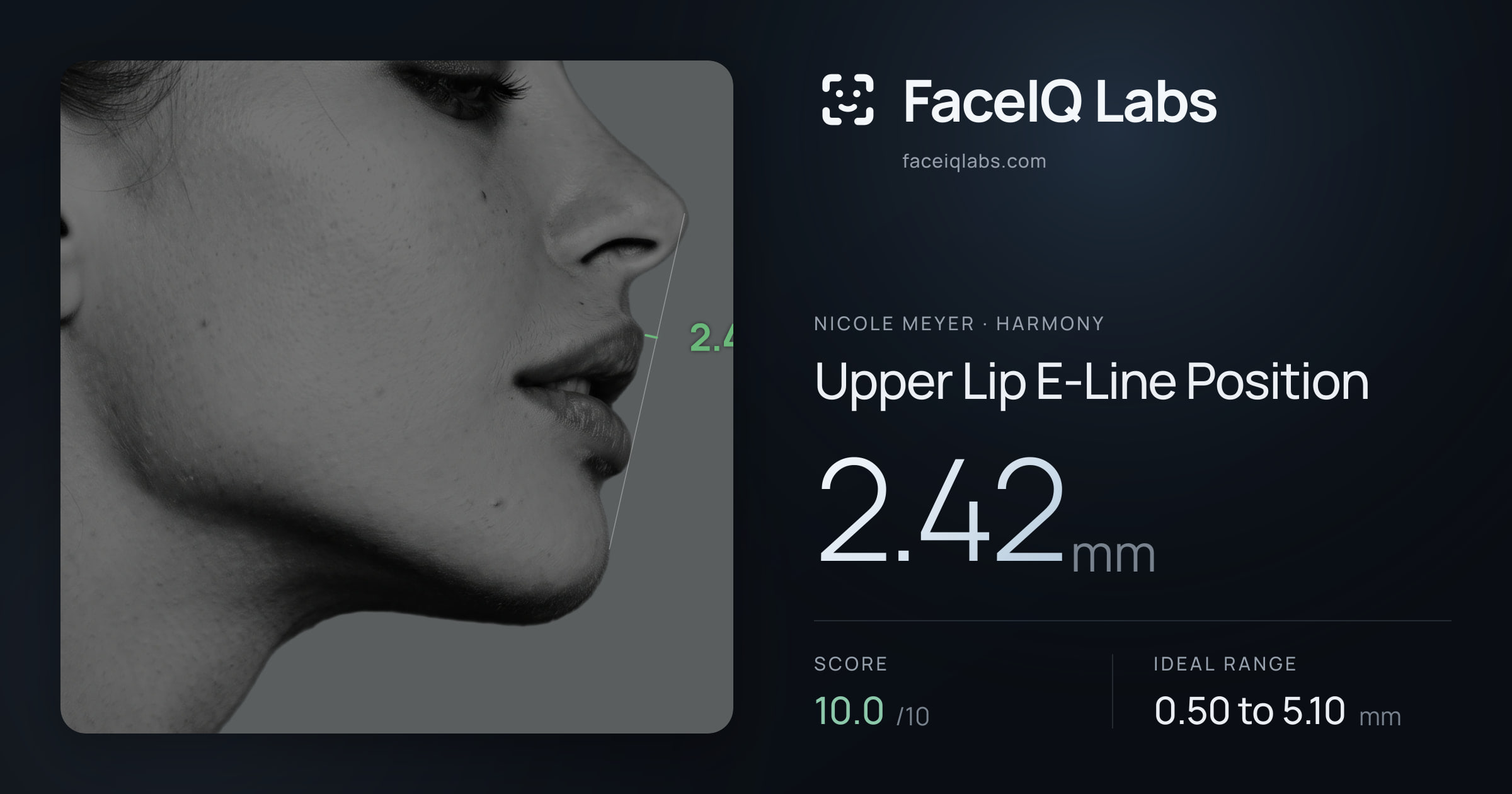 Nicole Meyer Upper Lip E-Line Position: 2.42mm, drawn on the photo