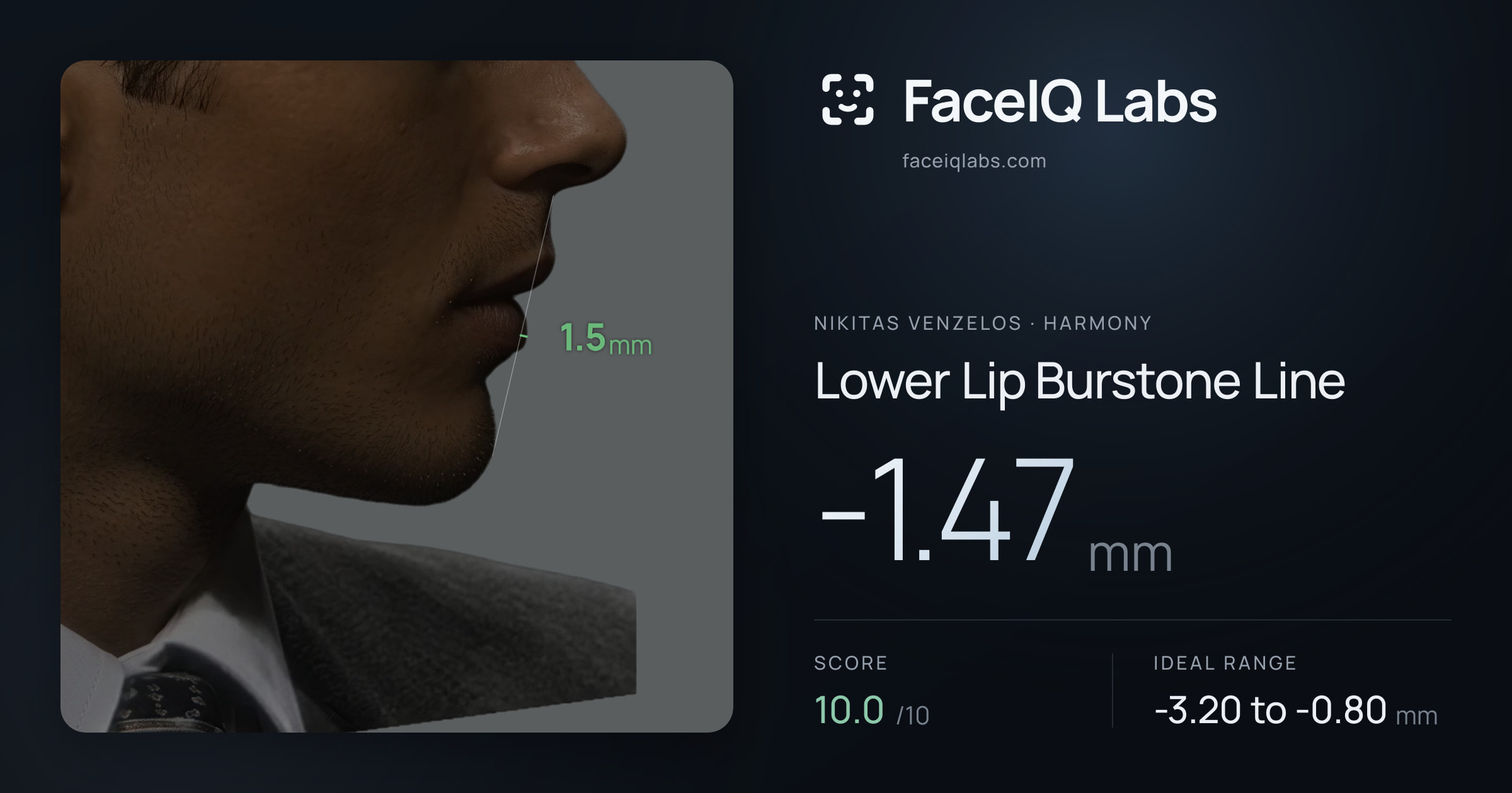 Nikitas Venzelos Lower Lip Burstone Line: -1.47mm, drawn on the photo