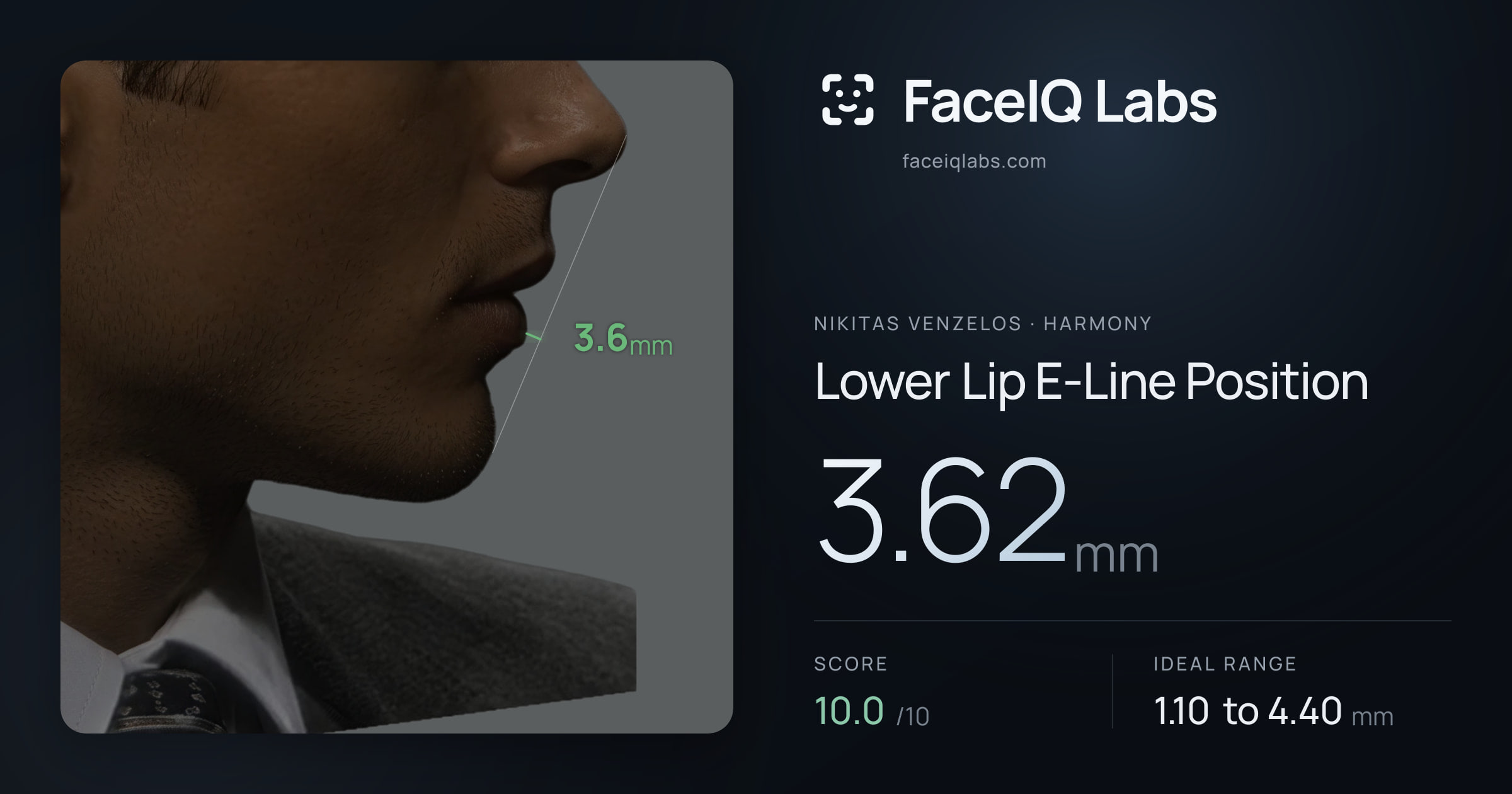 Nikitas Venzelos Lower Lip E-Line Position: 3.62mm, drawn on the photo