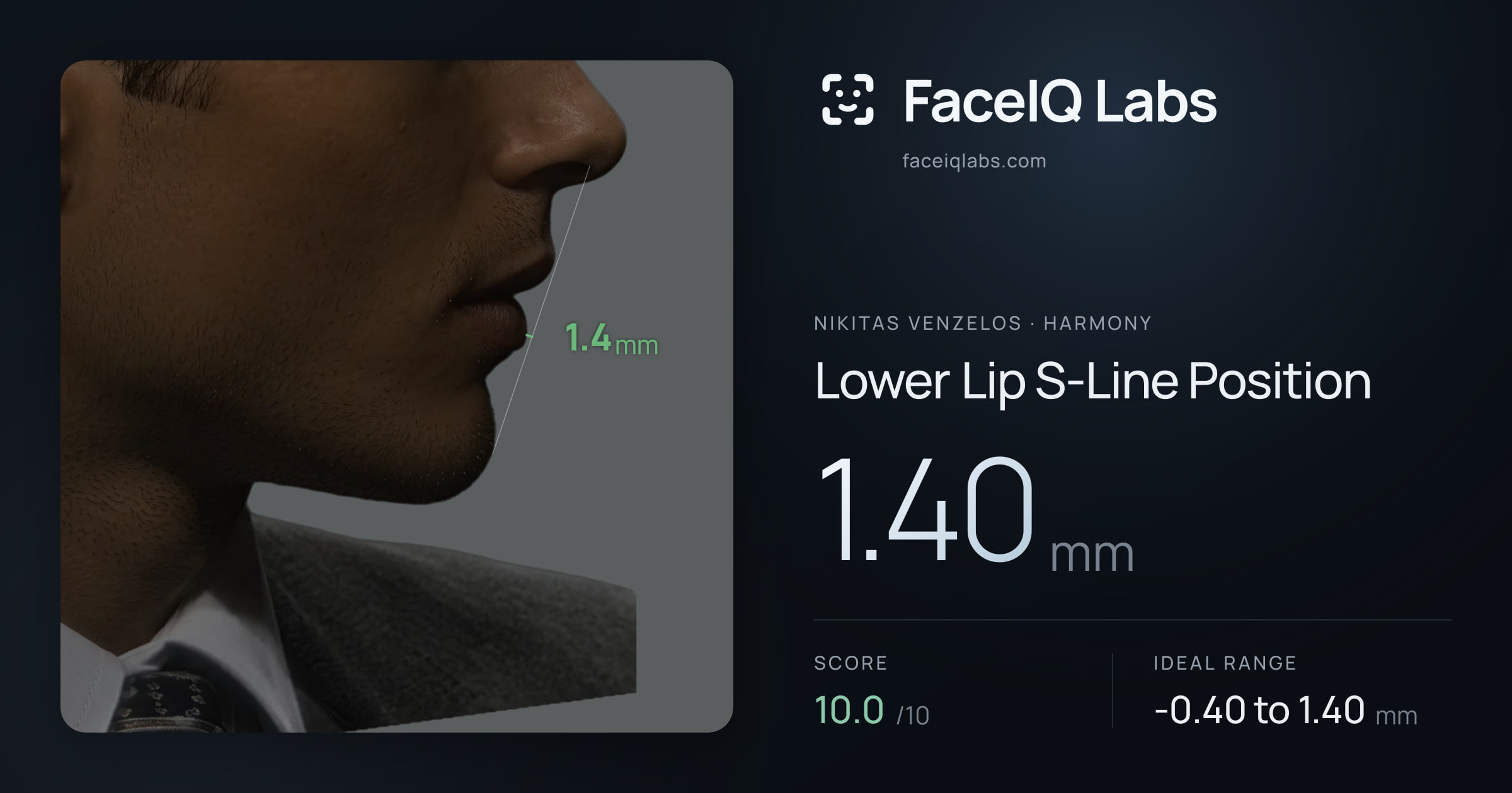 Nikitas Venzelos Lower Lip S-Line Position: 1.40mm, drawn on the photo