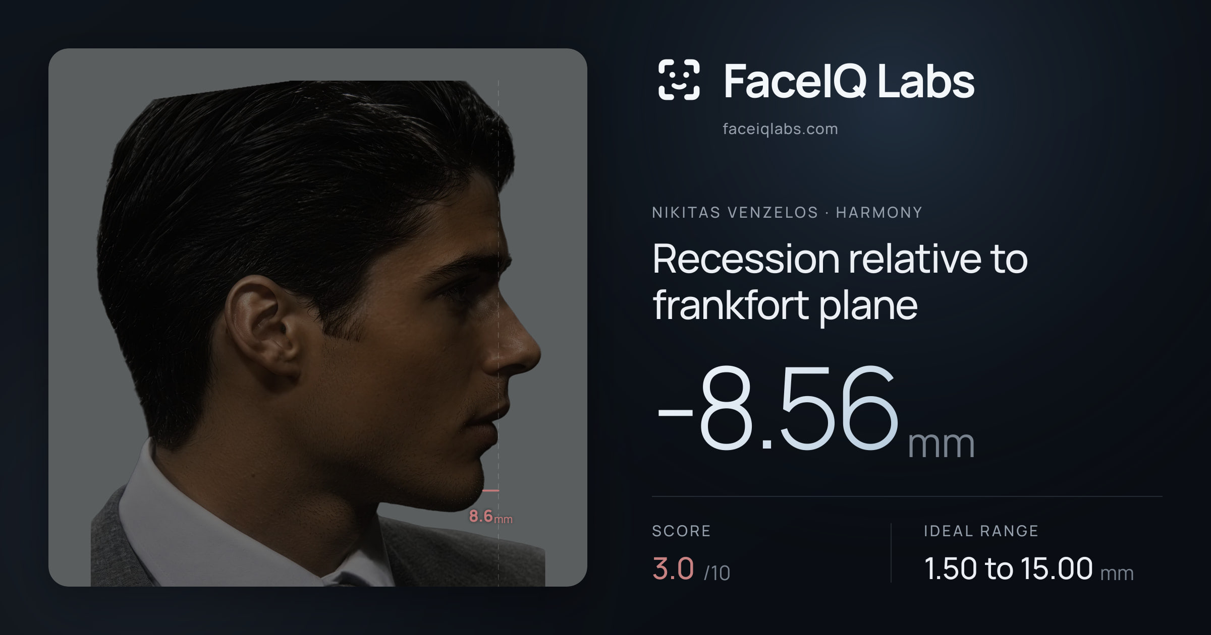 Nikitas Venzelos Recession relative to frankfort plane: -8.56mm, drawn on the photo