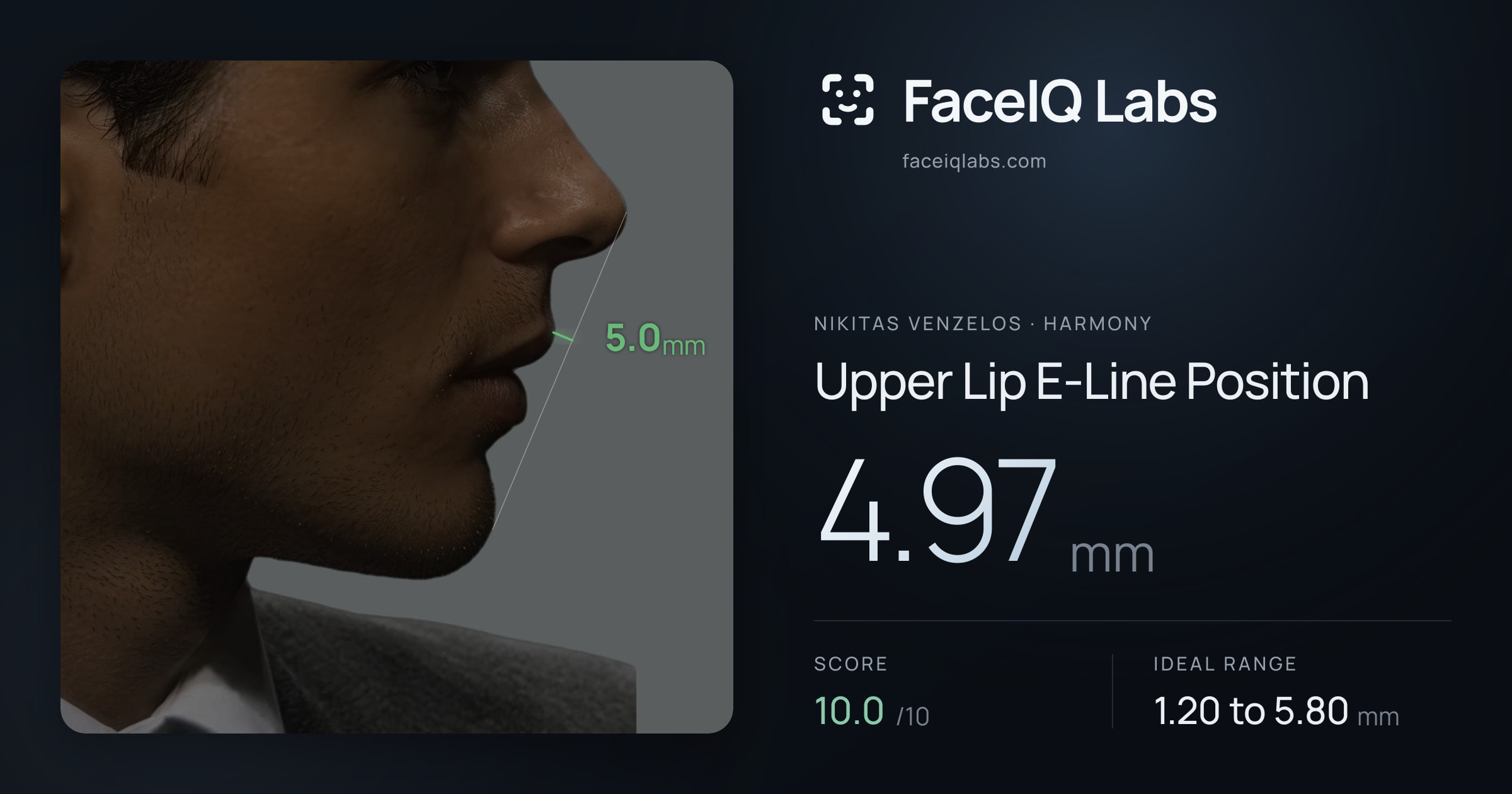 Nikitas Venzelos Upper Lip E-Line Position: 4.97mm, drawn on the photo