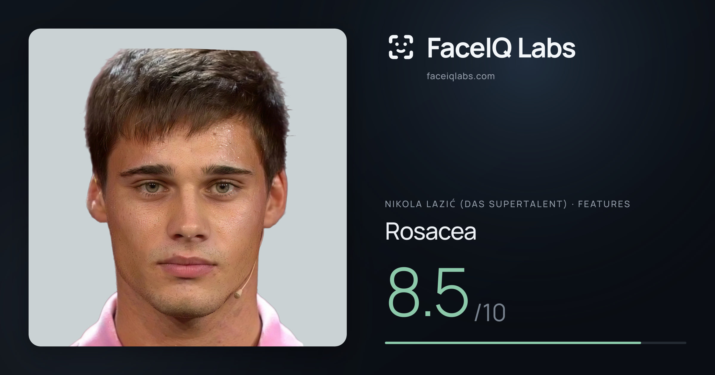 Nikola Lazić (Das Supertalent) Rosacea: 8.5/10, drawn on the photo