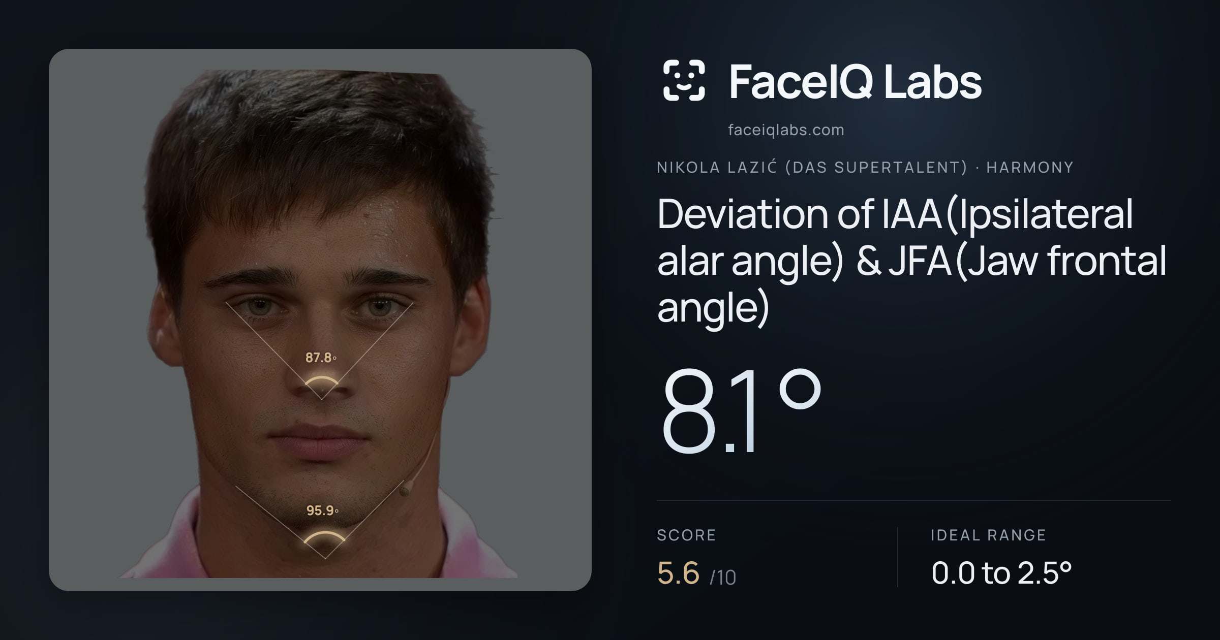 Nikola Lazić (Das Supertalent) Deviation of IAA(Ipsilateral alar angle) & JFA(Jaw frontal angle): 8.1°, drawn on the photo
