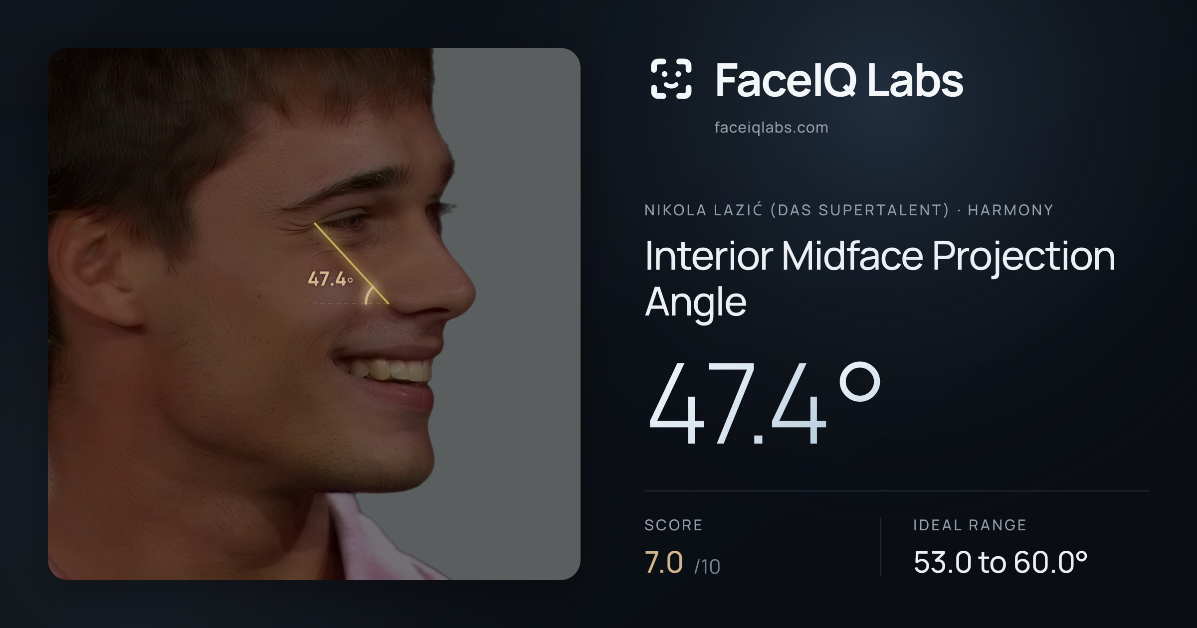 Nikola Lazić (Das Supertalent) Interior Midface Projection Angle: 47.4°, drawn on the photo