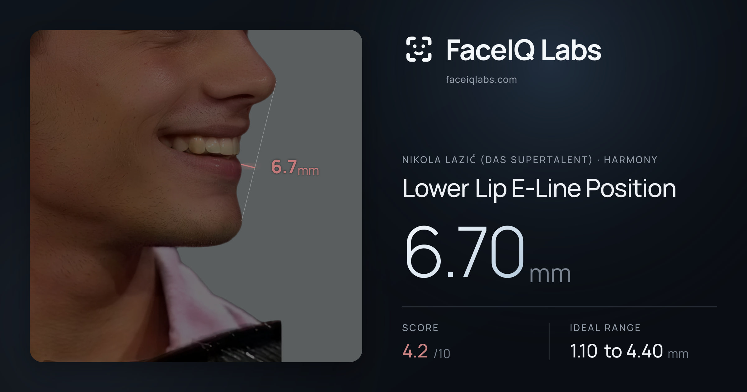 Nikola Lazić (Das Supertalent) Lower Lip E-Line Position: 6.70mm, drawn on the photo