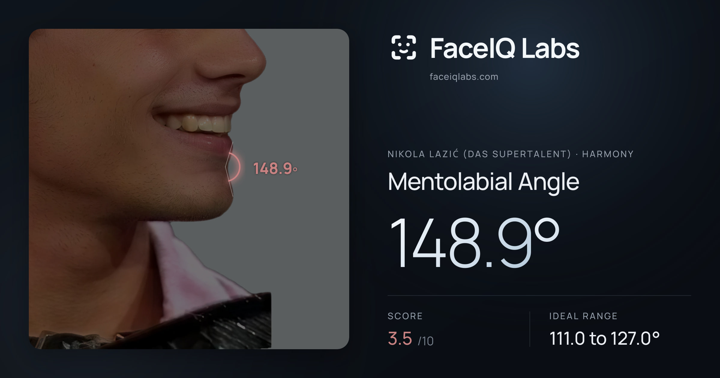 Nikola Lazić (Das Supertalent) Mentolabial Angle: 148.9°, drawn on the photo