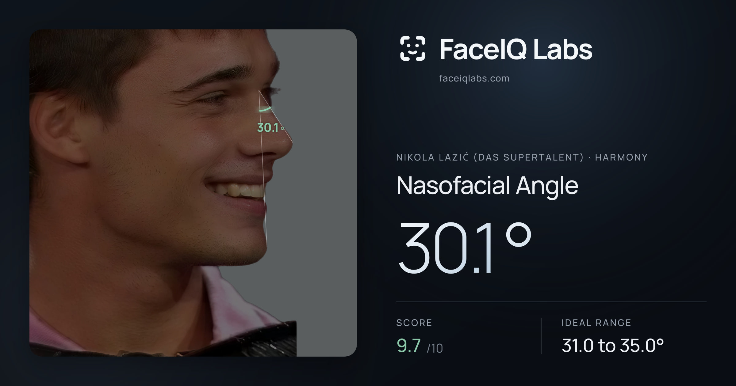 Nikola Lazić (Das Supertalent) Nasofacial Angle: 30.1°, drawn on the photo