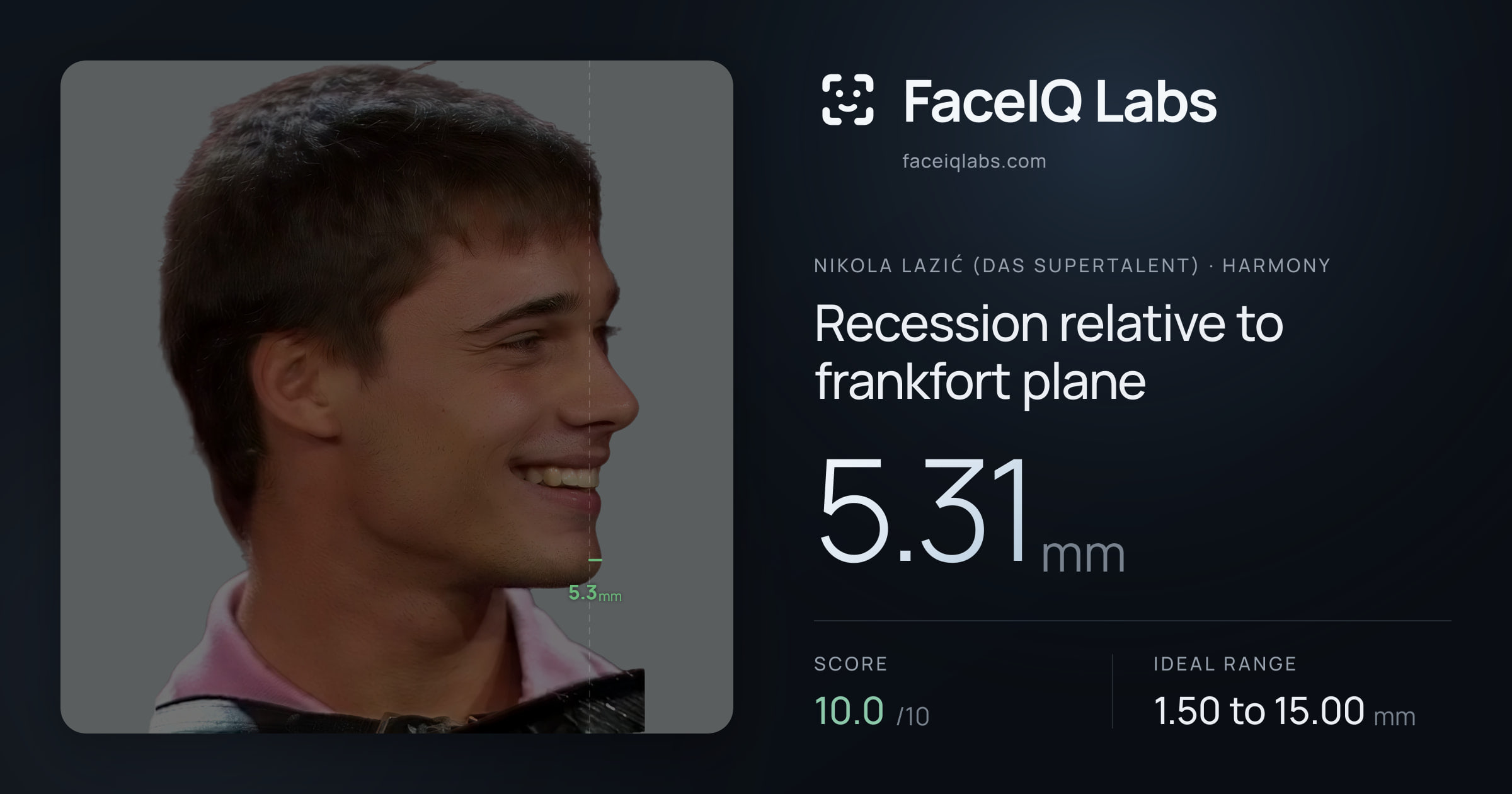 Nikola Lazić (Das Supertalent) Recession relative to frankfort plane: 5.31mm, drawn on the photo