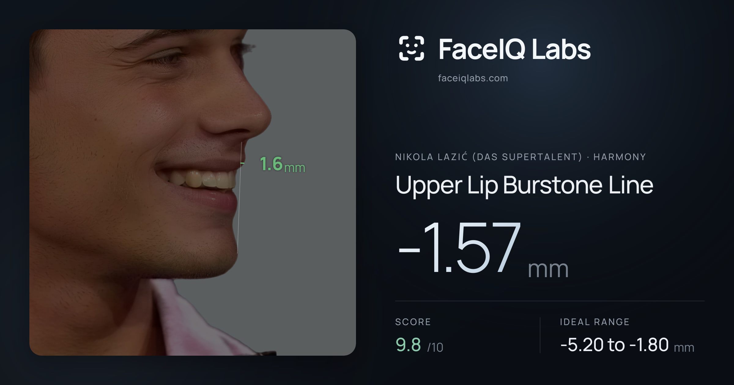 Nikola Lazić (Das Supertalent) Upper Lip Burstone Line: -1.57mm, drawn on the photo