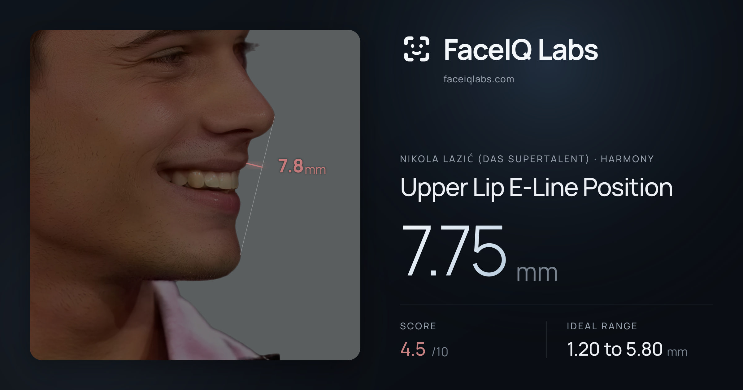 Nikola Lazić (Das Supertalent) Upper Lip E-Line Position: 7.75mm, drawn on the photo