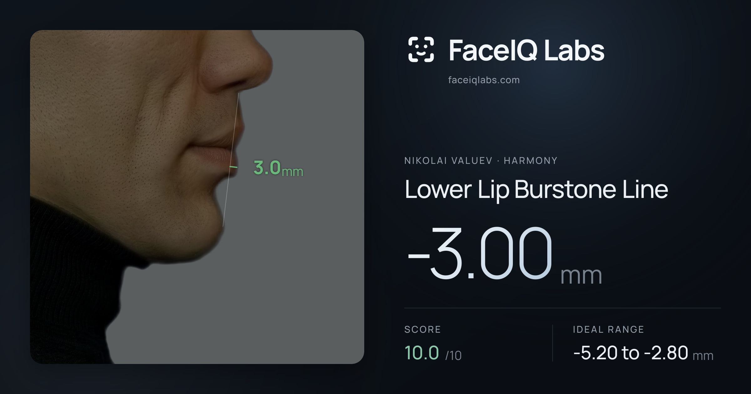 Nikolai Valuev Lower Lip Burstone Line: -3.00mm, drawn on the photo