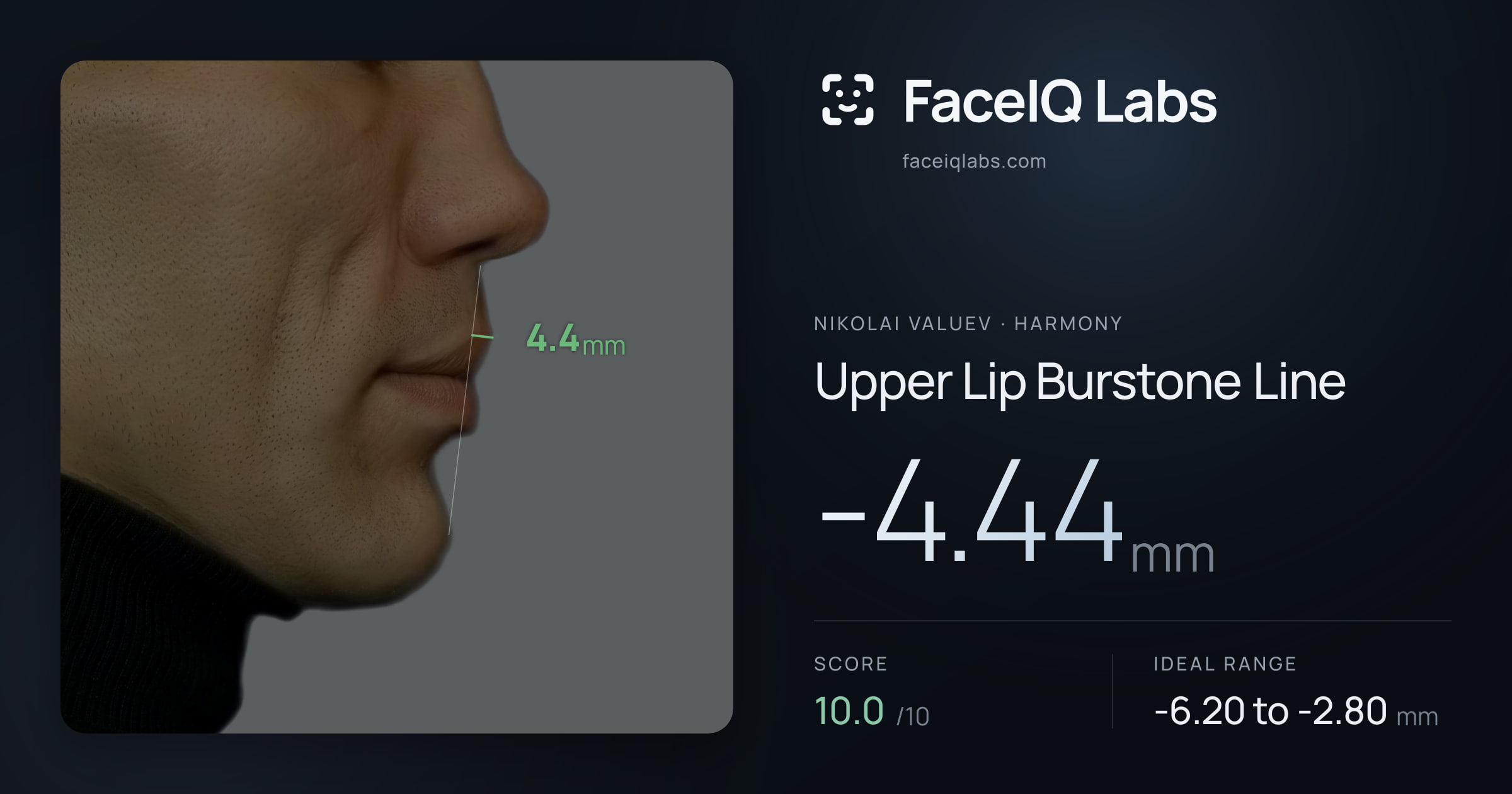 Nikolai Valuev Upper Lip Burstone Line: -4.44mm, drawn on the photo