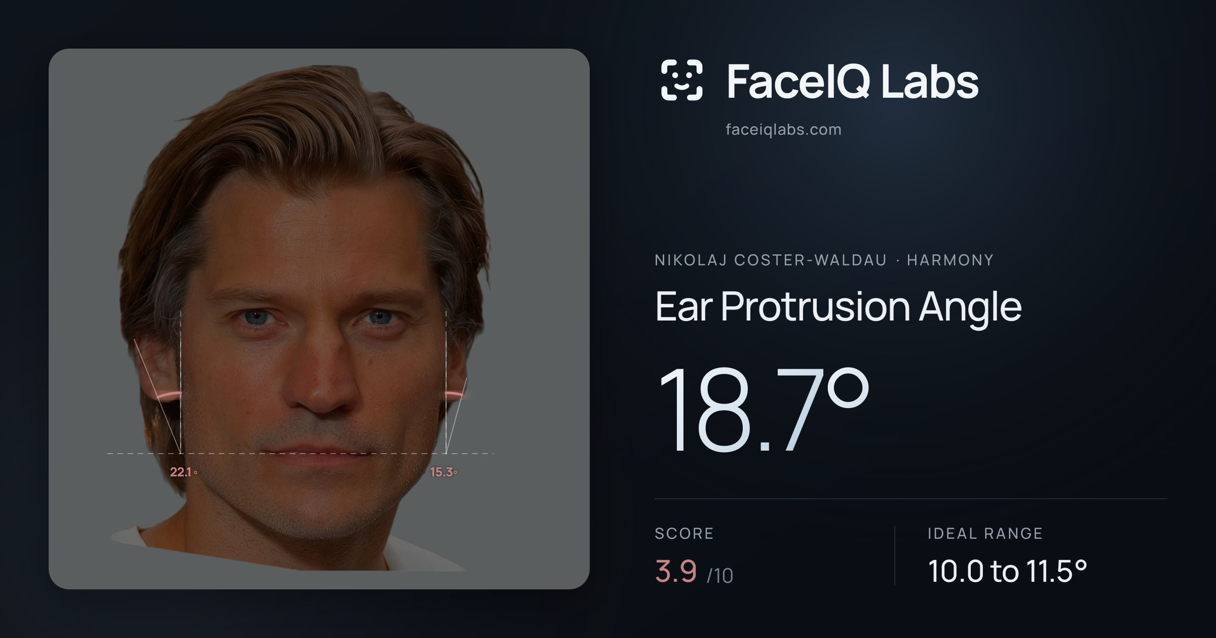 Nikolaj Coster-Waldau Ear Protrusion Angle: 18.7°, drawn on the photo