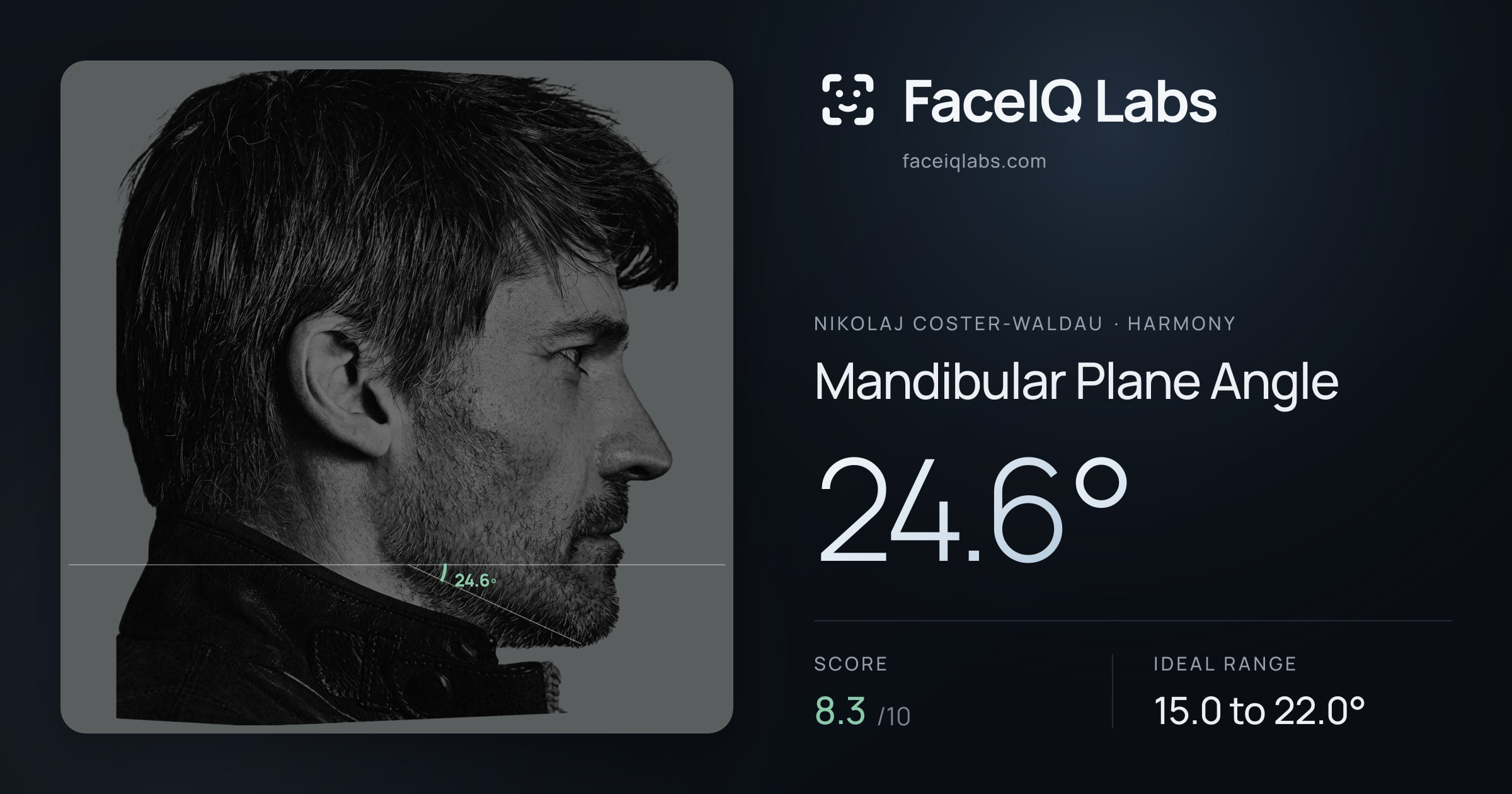 Nikolaj Coster-Waldau Mandibular Plane Angle: 24.6°, drawn on the photo