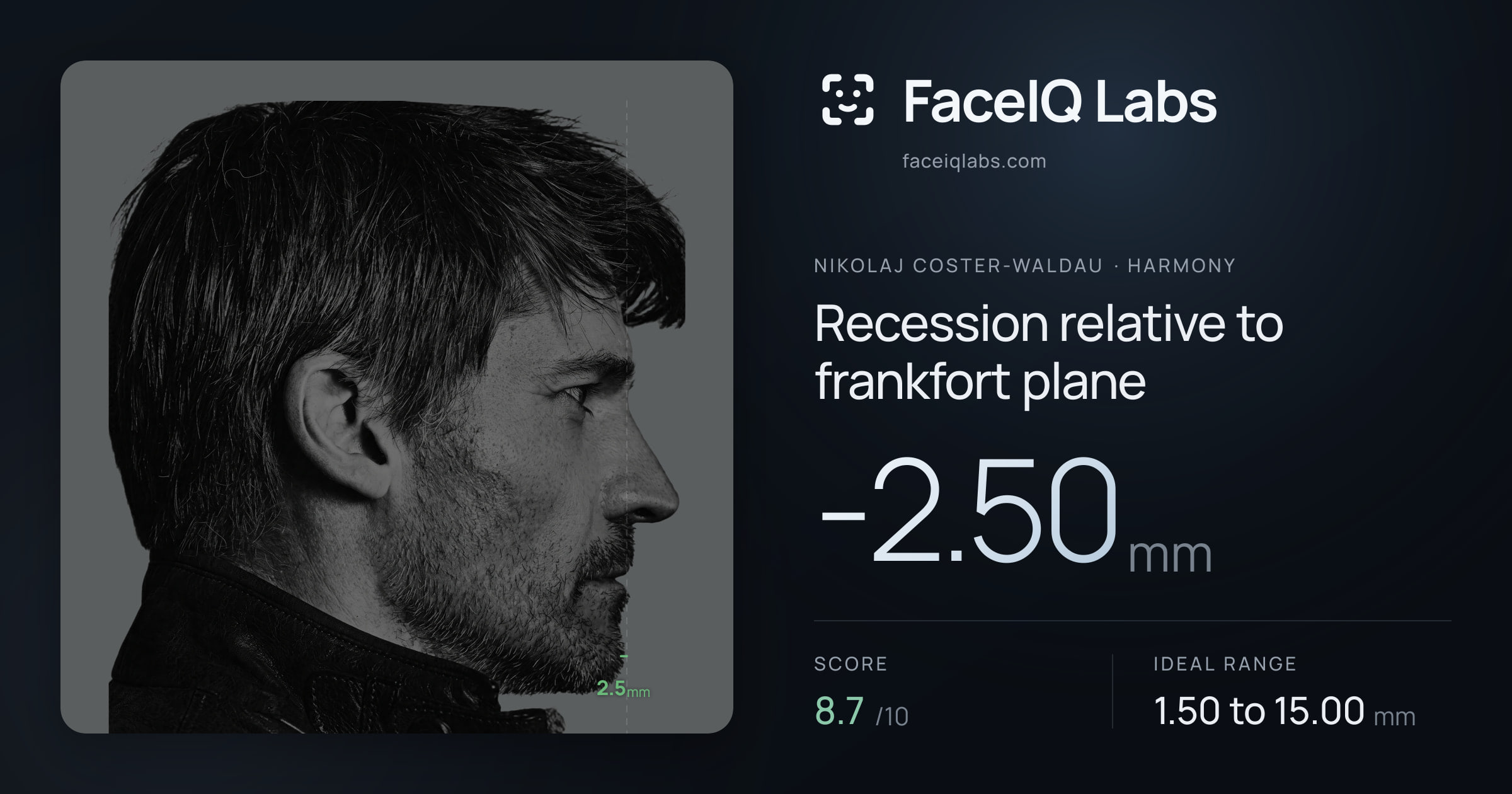 Nikolaj Coster-Waldau Recession relative to frankfort plane: -2.50mm, drawn on the photo
