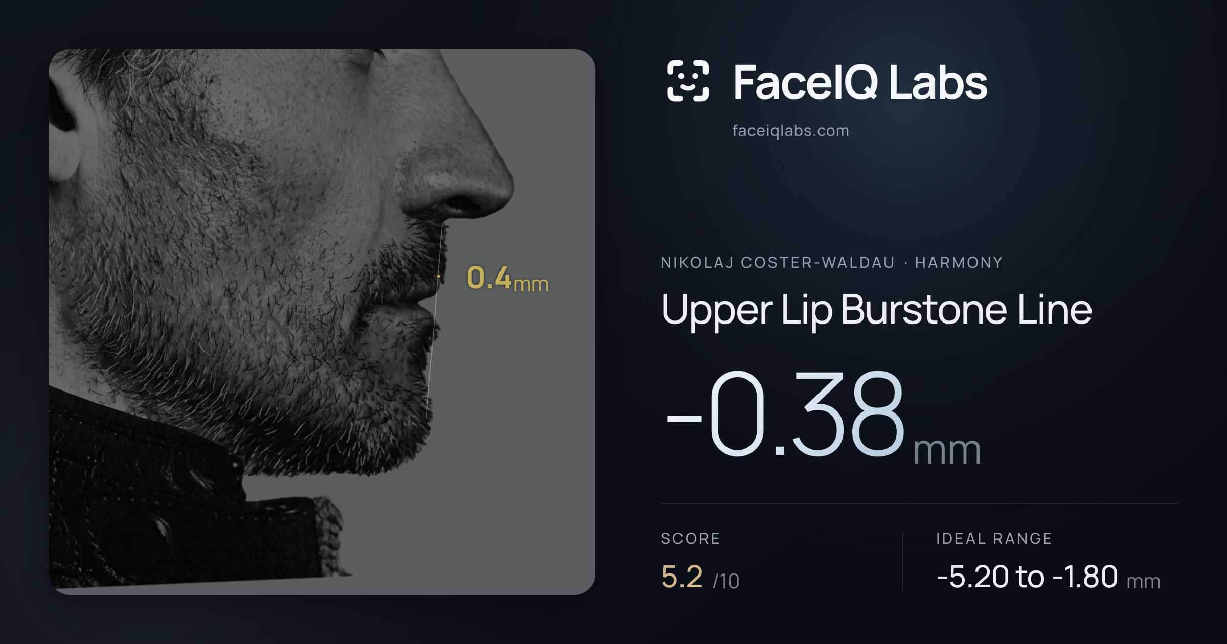 Nikolaj Coster-Waldau Upper Lip Burstone Line: -0.38mm, drawn on the photo