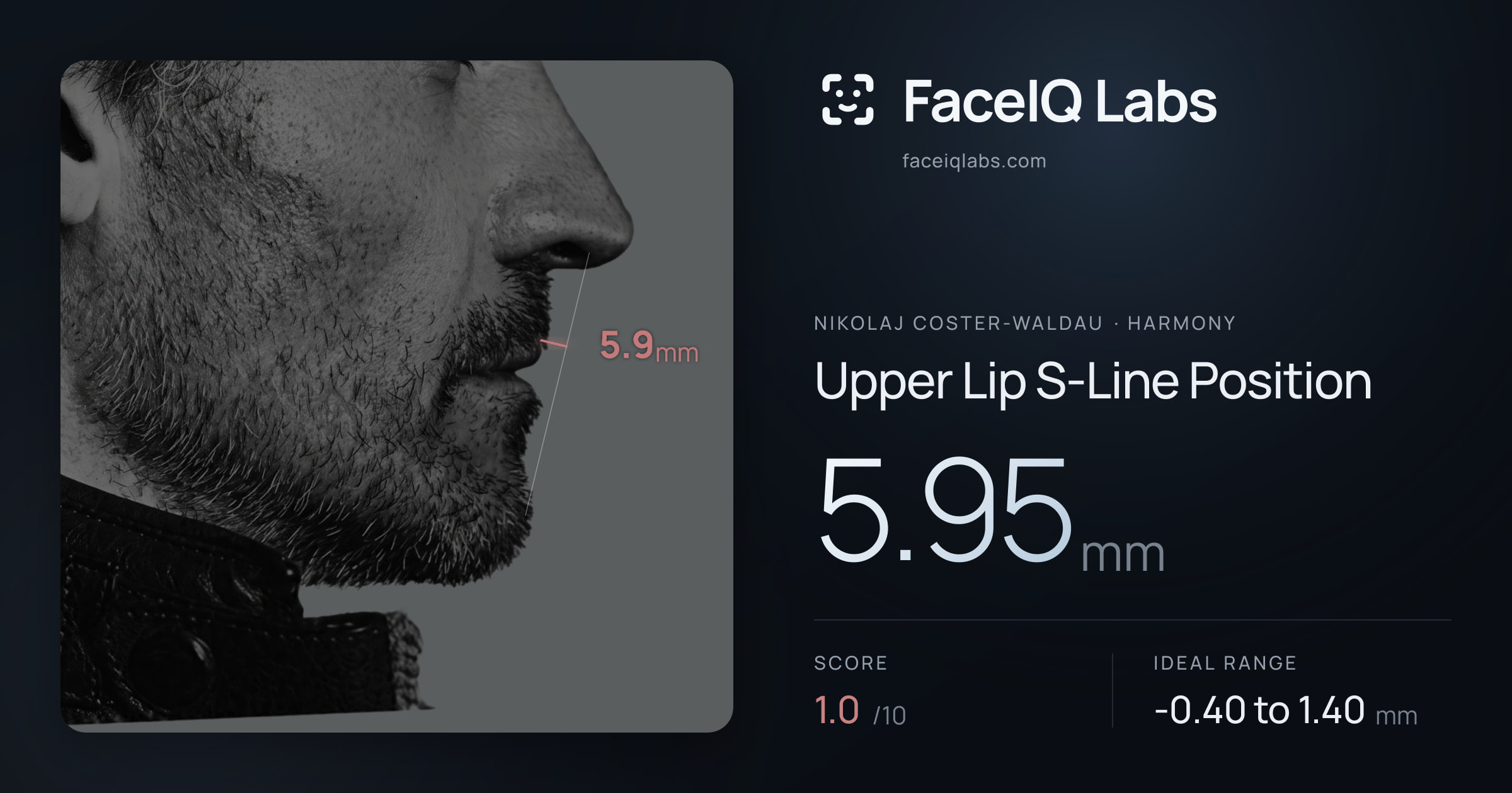 Nikolaj Coster-Waldau Upper Lip S-Line Position: 5.95mm, drawn on the photo