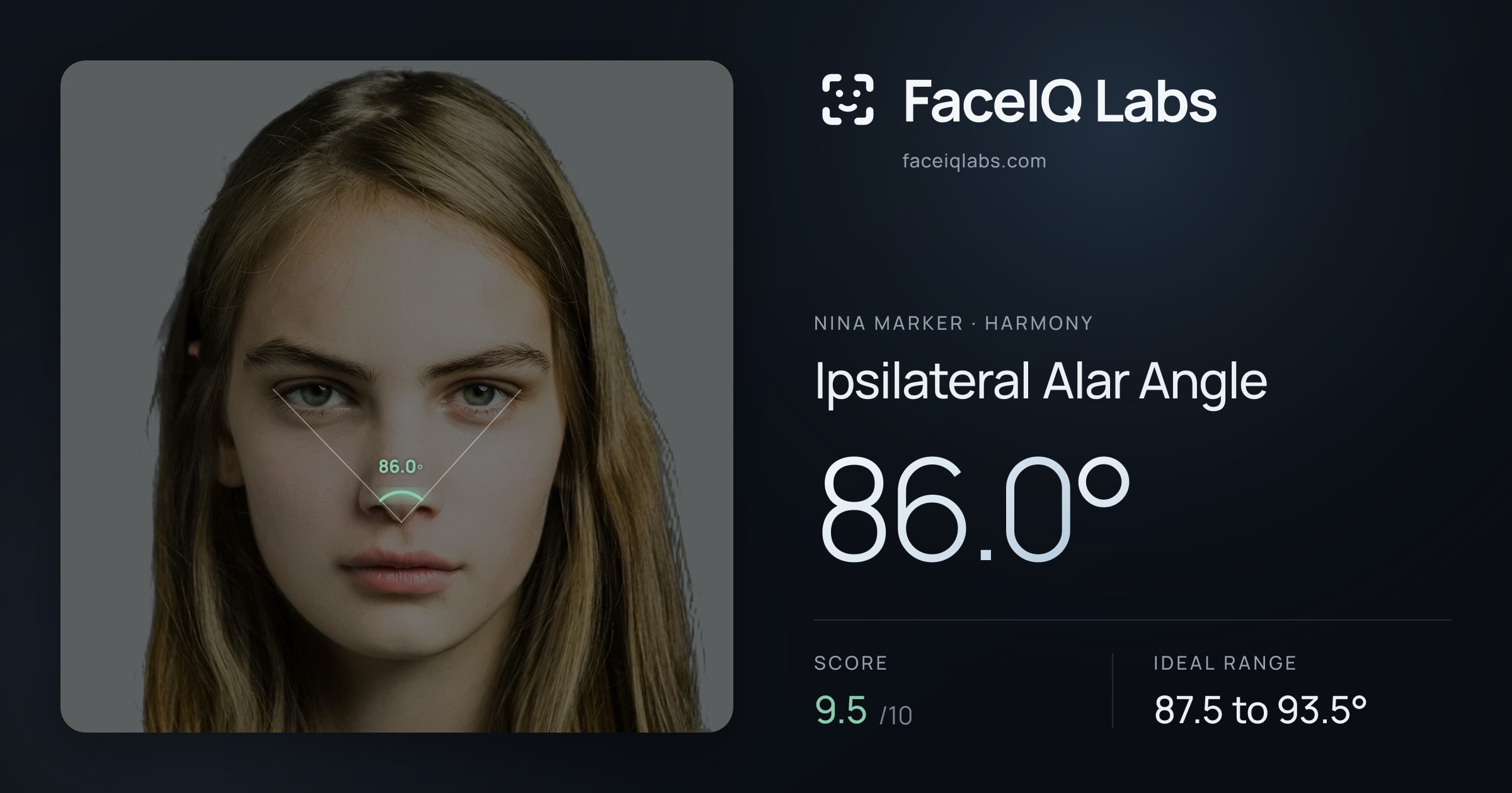 Nina Marker Ipsilateral Alar Angle: 86.0°, drawn on the photo