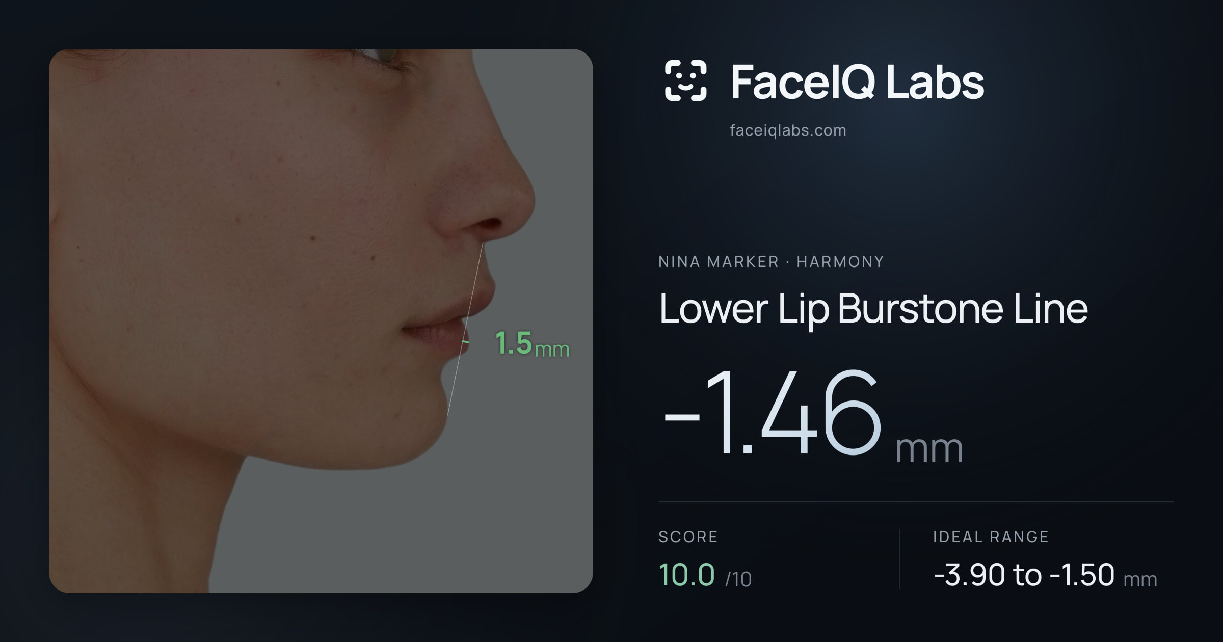 Nina Marker Lower Lip Burstone Line: -1.46mm, drawn on the photo