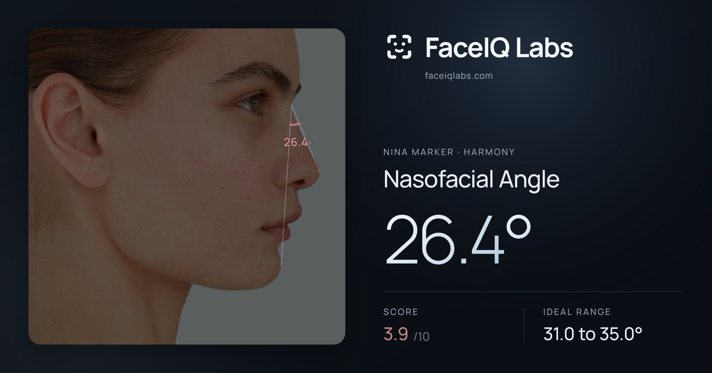 Nina Marker Nasofacial Angle: 26.4°, drawn on the photo