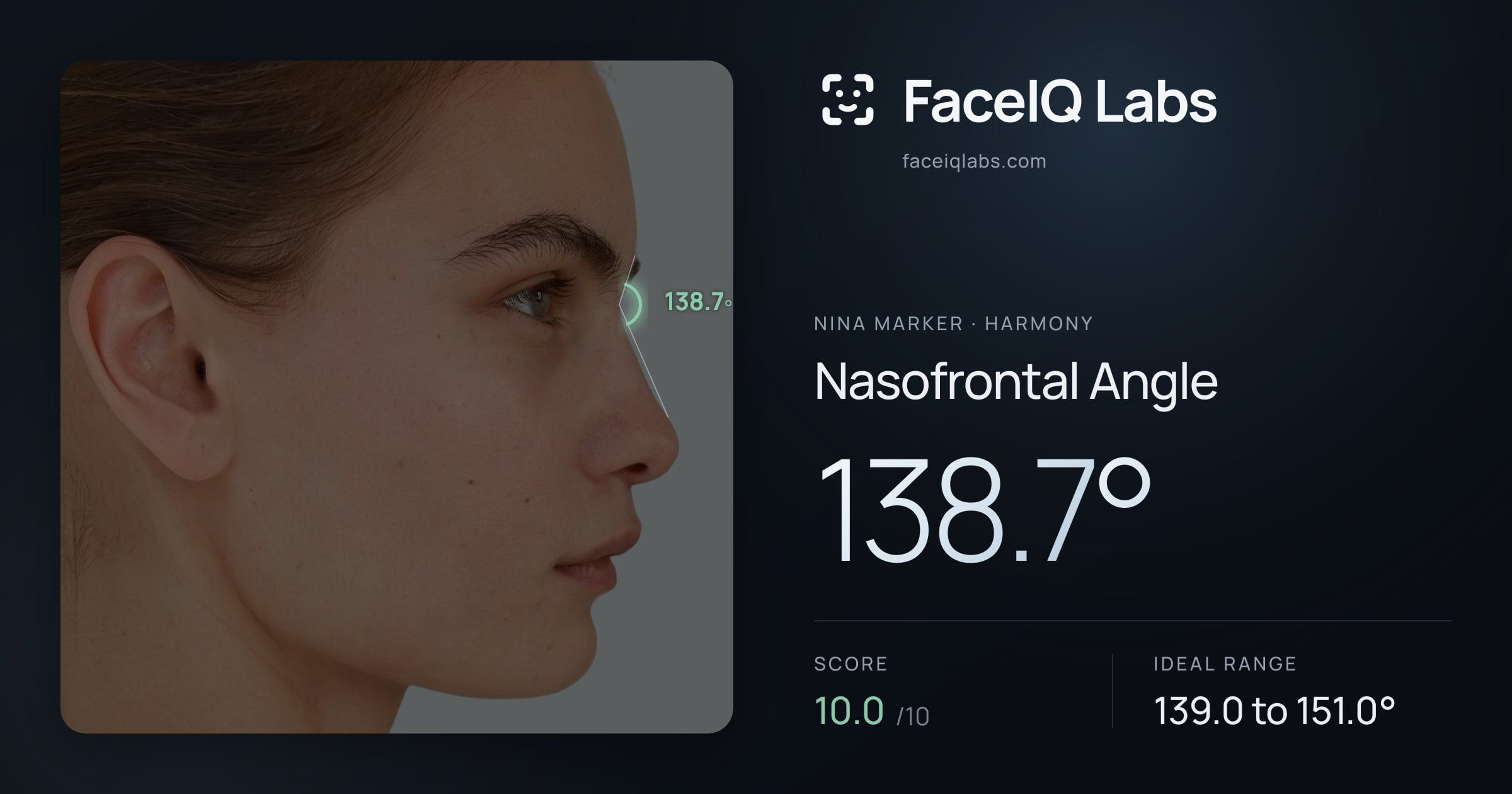 Nina Marker Nasofrontal Angle: 138.7°, drawn on the photo