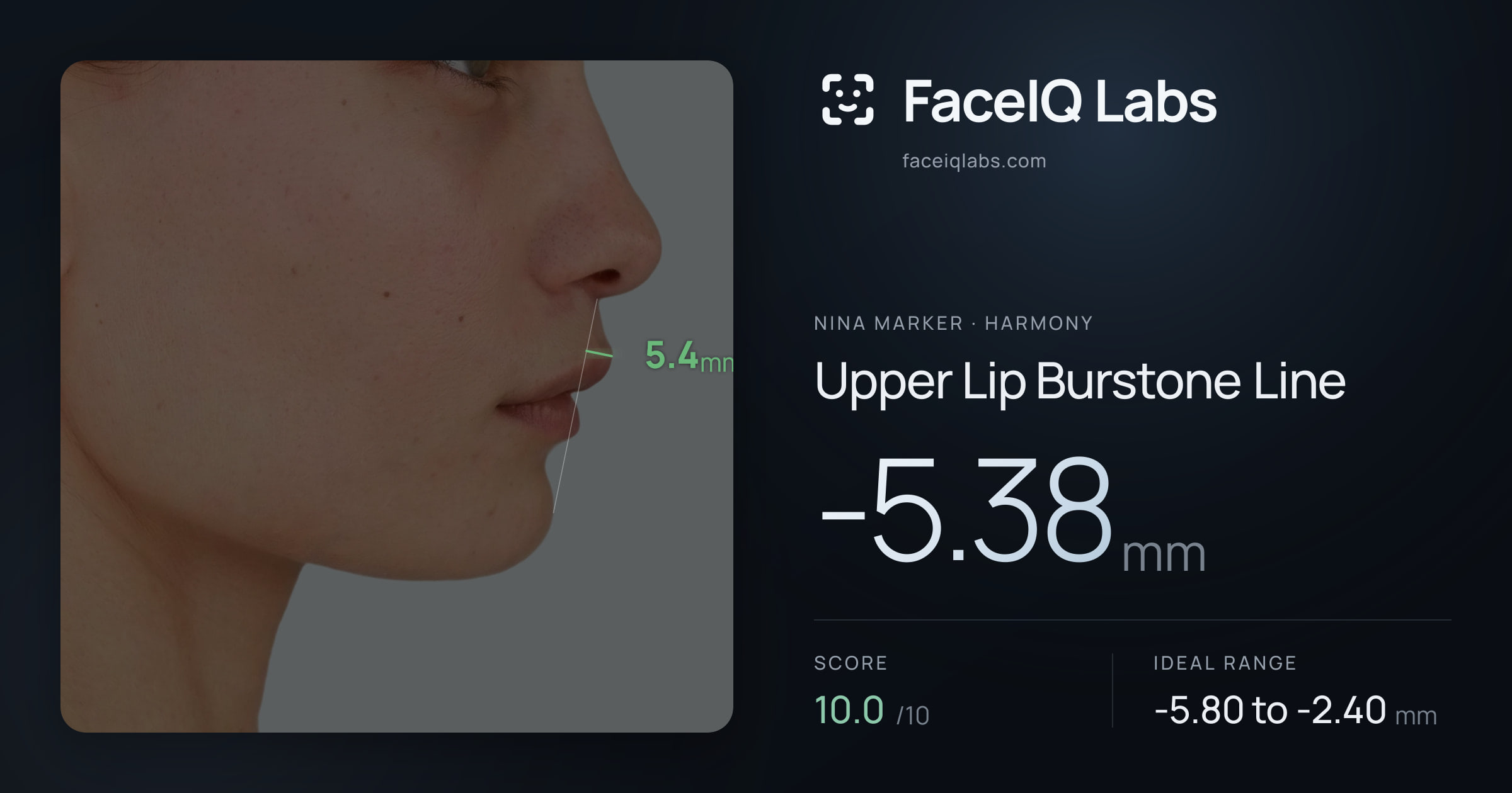 Nina Marker Upper Lip Burstone Line: -5.38mm, drawn on the photo
